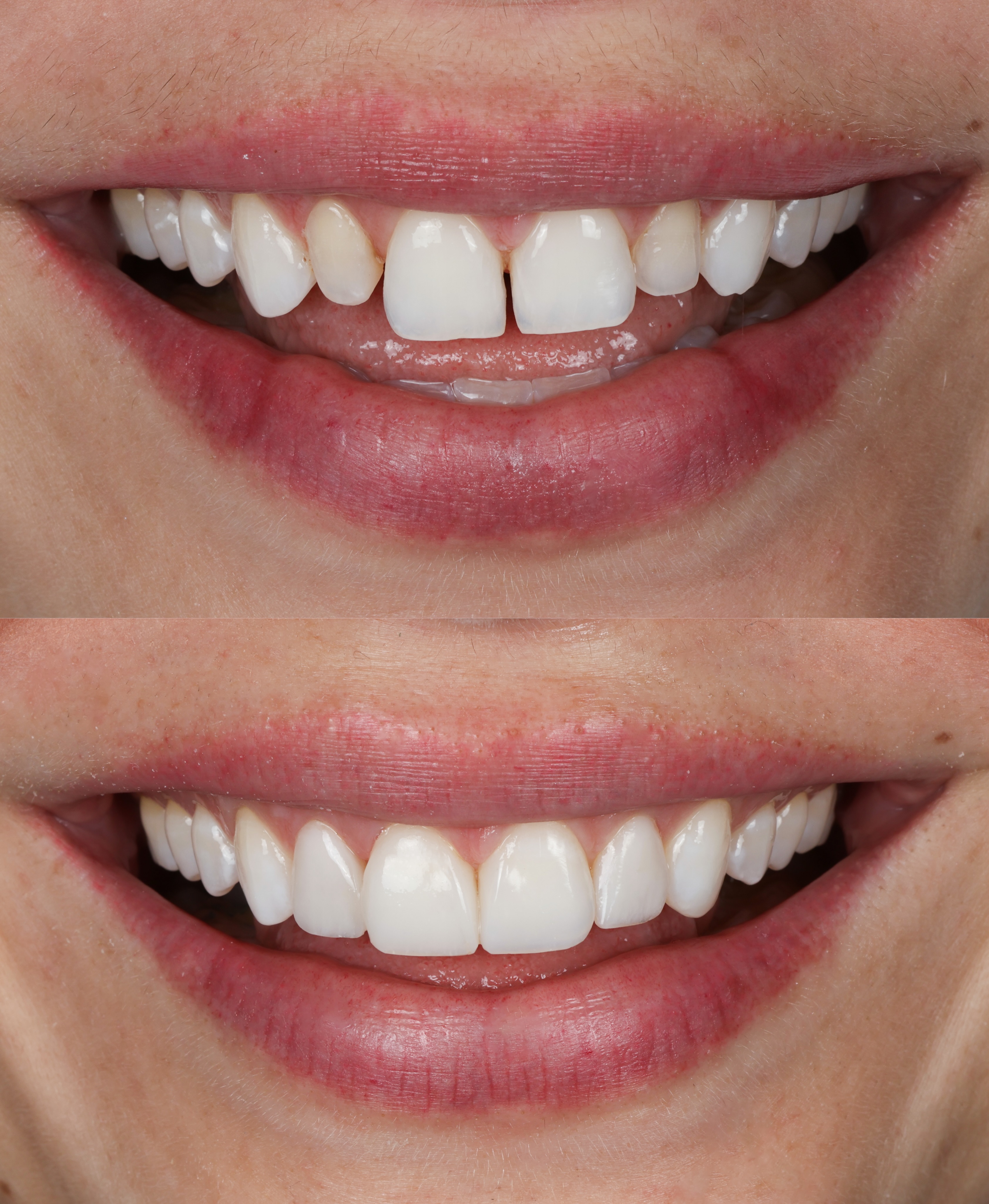 Um antes e depois de RESPEITO!
Caso de facetas em resina composta pra essa paciente linda e mais que especial! 🌷