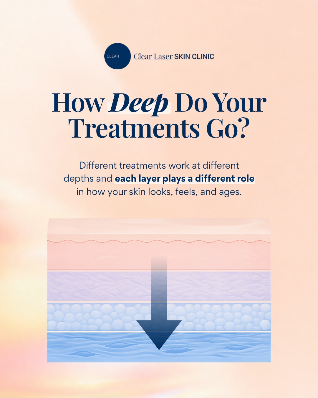 Not all lifting treatments work at the same depth.
Your skin is made up of multiple layers, and each treatment is designed to target a specific one. That's why choosing the right technology matters just as much as choosing the right clinic.
Ultherapy PRIME is unique because it delivers focused ultrasound energy to the SMAS layer—the same foundational layer targeted during a surgical facelift, without surgery.
At Clear Laser SKIN CLINIC, we don't believe in one-size-fits-all treatments. We recommend the most effective technology based on your skin, your concerns, and your goals.
Experience the next generation of non-surgical lifting with Ultherapy PRIME.
📍Now available at Clear Laser SKIN CLINIC
#ClearLaserSKINCLINIC #UltherapyPRIME #Ultherapy #KbeautiyLifting #Tightening