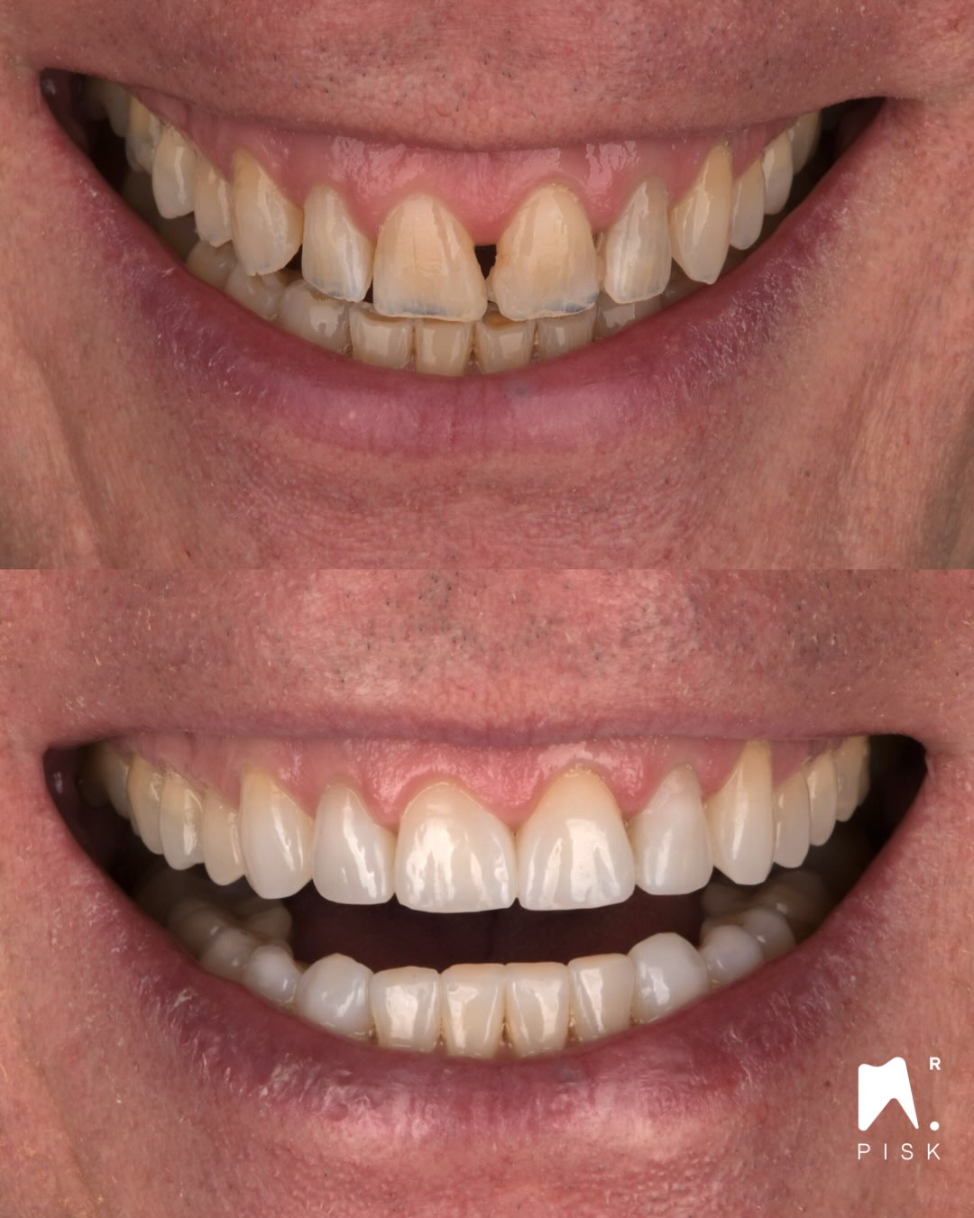 Injection of composite : You want to learn about that ? Link in Bio
Treatment of wear with an additiv treatment by composite
Main etiology : nocturn bruxism
Material : gaenial Universal injectable OA2 as dentin and JE as enamel