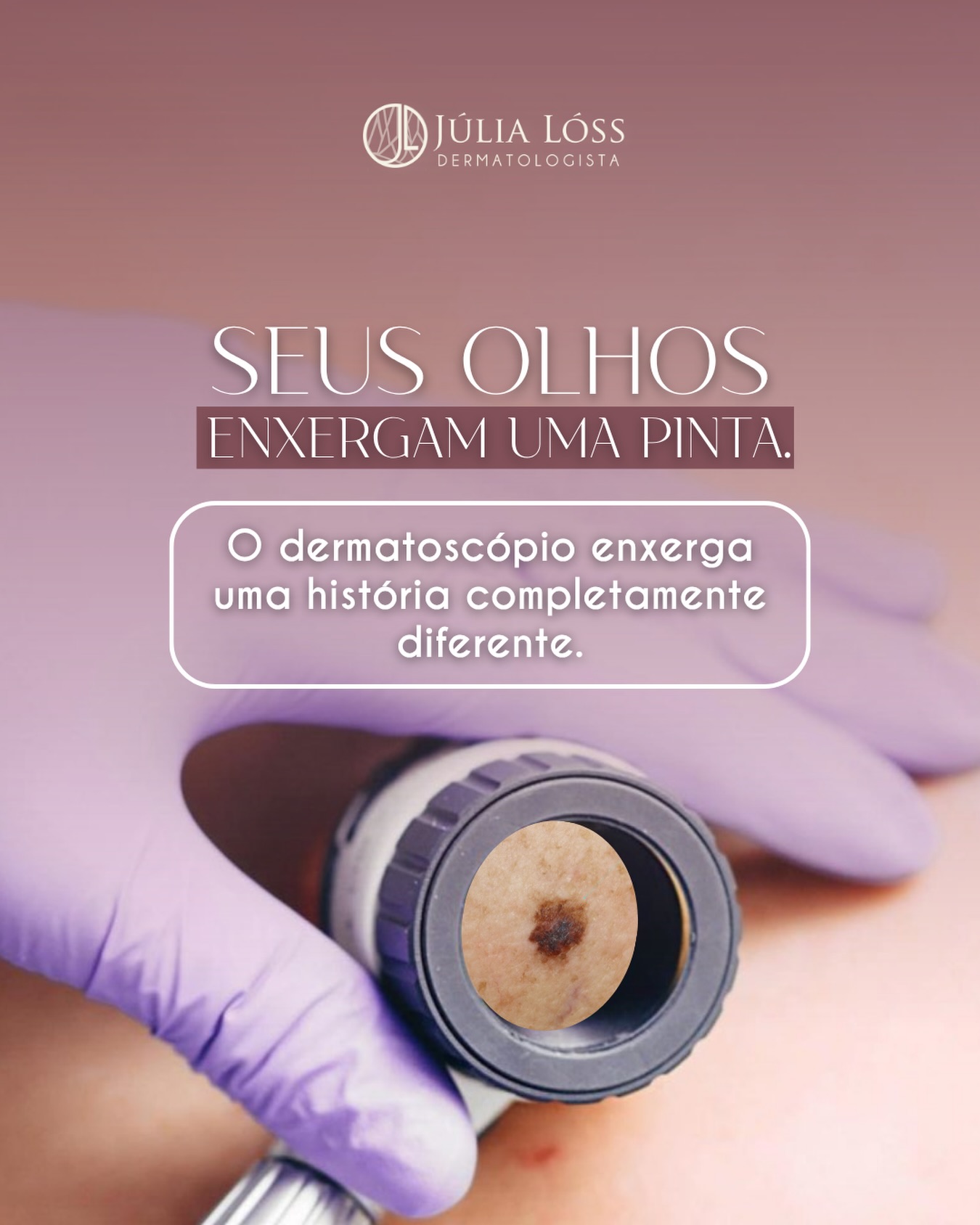 Uma pinta pode parecer completamente comum quando observada a olho nu. Mas, com o auxílio da dermatoscopia, é possível visualizar estruturas que não são perceptíveis no exame convencional e que ajudam a diferenciar lesões benignas de alterações que merecem investigação.
Esse exame permite analisar padrões de pigmentação, vasos e outros detalhes importantes, aumentando a precisão da avaliação dermatológica e contribuindo para o diagnóstico precoce do melanoma e de outros tipos de câncer de pele.
Dra. Júlia Lóss - Médica Dermatologista Oncológica
CRM 5201085638 RQE 34041
#DermatologiaOncologica #fotofinder #DermatologiaNiteroi #Dermatoscopia #melanoma