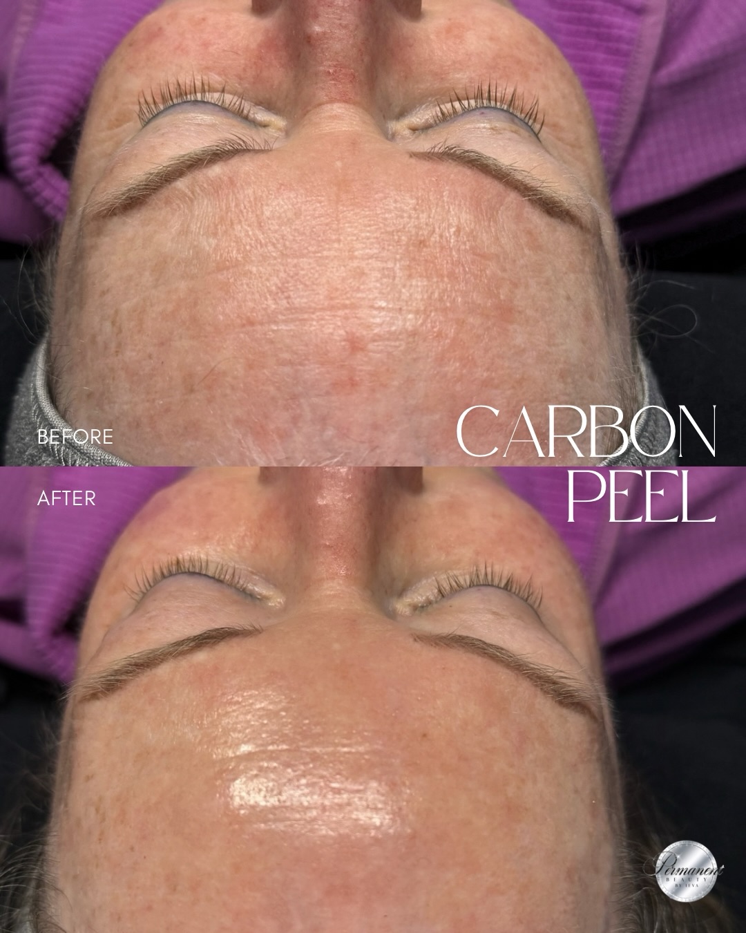 That’s not a filter, that’s one Carbon Peel session✨
Hollywood peel makes real difference: smoother texture, more even tone, and skin that’s visibly brighter and more refreshed with no downtime.
➡️ How it works: A carbon layer is applied to the skin, absorbing deep into pores along with oil and impurities. A laser then targets and vaporizes it, taking the buildup with it while gently resurfacing the top layer of skin.
We finish every session with a specialized mask or serums for extra glow and longer-lasting results, plus a facial massage — so you leave completely relaxed.
Follow the link in BIO to book your session 🤍
____________________________________________________
Permanent Makeup Services, Tattoo Removal & Carbon Laser Facial
⬆️Book apt with the link in bio
✨Free Consultation available
📍Oshawa, Ontario
✉️ browsbyieva@gmail.com
📱 +1 416-804-6749
Website: permanentbeautybyieva.com
#carbonpeel #oshawafacials #whitbyfacials #oshawamedspa #oshawasalon