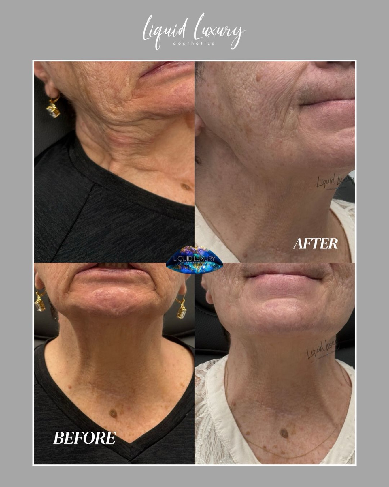The Nefertiti Lift is all about softening the downward pull of the neck muscles to create a smoother, more defined jawline. ๐
Using Jeuveau, we can strategically treat the lower face and neck for a subtle lifted effect without changing what makes you look like you.
๐ (631) 760-1124
๐ www.liquidluxuryaesthetics.com
๐ 1030 W Jericho Tpke Suite 5 Smithtown, NY 11787
๐ง info@liquidluxuryaesthetics.com
๐ฉ๐ผโโ๏ธ Ina LaRocca-Tocco, FNP-C
๐คณ TikTok: liquidluxury_aesthetics
#NefertitiLift #Jeuveau #JawlineDefinition #LongIslandMedSpa #Tox