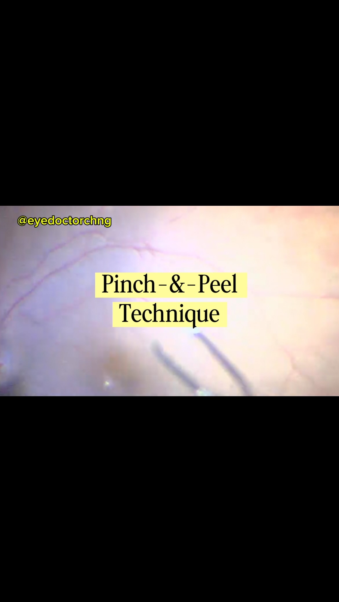 There are many techniques to initiate an internal limiting membrane peel during a macular hole repair surgery. The pinch and peel technique remains the most common as demonstrated here.
#vitreoretinalsurgery #macularhole #ophthalmology #vitreoretinal #eyedoctorchng