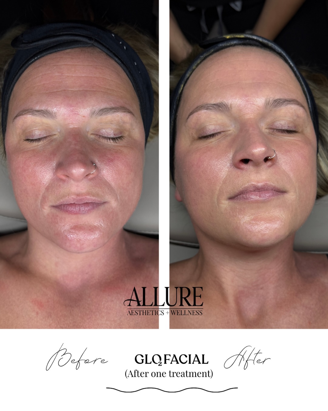 🤩look at the difference for our beautiful patient @krmanderscheid after just one Glo2Facial Premium treatment !
.
•decreased fine lines and wrinkles
•improved skin tone
•decreased redness
•glowing skin
.
BOOK AN APPOINTMENT •
💻www.allureaw.com
📞 563-258-4698
📧 info@allure-dbq.com
.
•FOLLOW •
Nicole Powers, ARNP, AGNP-BC
@nicolepowers_np
Allure Aesthetics + Wellness
@allure_iowa
@glo2facial
#maquoketa #glo2facial #medspa #nursepractitioner