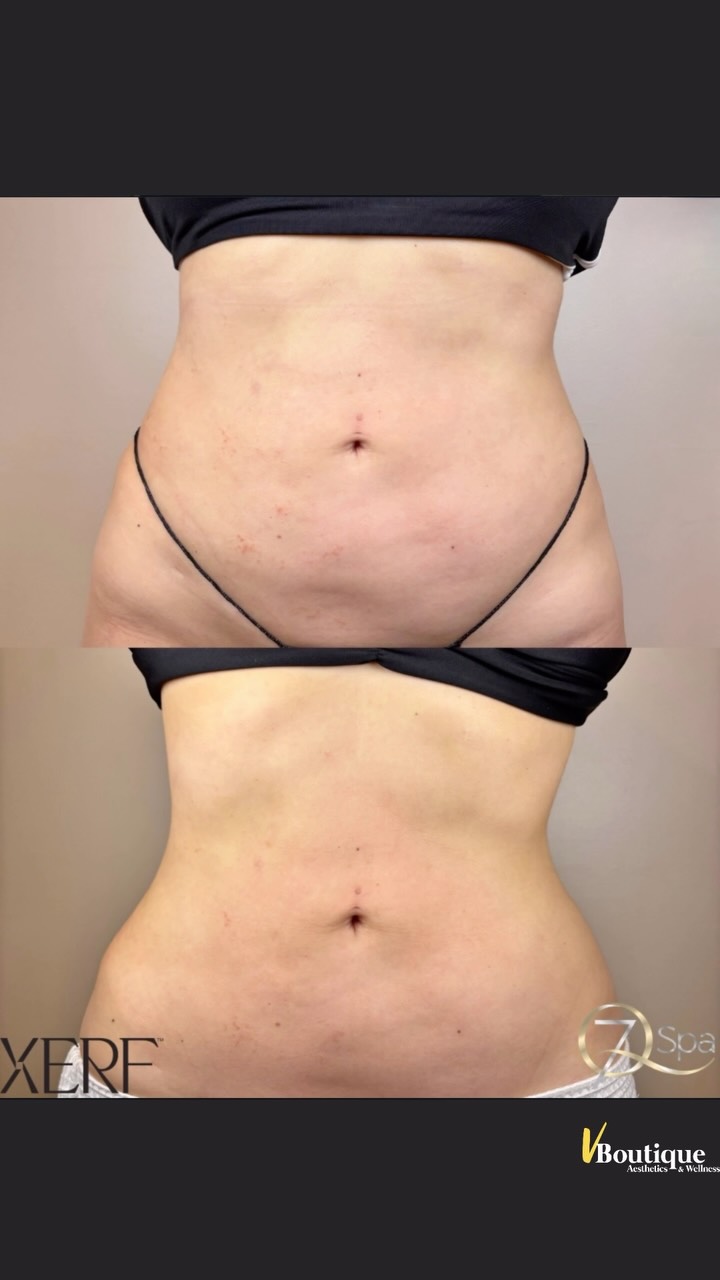 ✨ XERF™️ BODY TIGHTENING — when tighter skin creates better contours ✨. Take a close look at this patient’s abdomen.
What stands out is the beautifully defined contour and visibly tighter skin—and this is NOT the result of fat loss.
It’s the result of structural skin tightening.
Think of it this way: when loose skin becomes firmer and “snaps back” against the underlying structures, it can act almost like a natural girdle. The abdomen can appear smoother, tighter and even slimmer—not because we removed fat, but because the skin is hugging the body more beautifully. 🔥
So what makes XERF™️ different?
XERF™️ is a newer K-Beauty/Korean radiofrequency technology designed for structural skin tightening of the face AND body. 🇰🇷✨
Unlike traditional RF treatments that primarily target a single tissue depth, XERF™️ uses dual-frequency radiofrequency energy to deliver controlled heat at different depths—from more superficial tissues to deeper structural layers.
🔥 Superficial heating helps address skin quality, firmness and collagen remodeling.
🔥 Deeper heating targets the deeper tissue layers that contribute to laxity and overall contour.
And XERF™️ isn’t just for the abdomen. We can use it throughout the face and body wherever improved firmness and structural support are desired.
For some patients, XERF™️ is beautiful as a stand-alone treatment. For others, we may create a customized combination plan using treatments such as Sculptra®️, Radiesse®️, injectables or complementary skin-tightening technologies to address different layers and optimize the overall result. 💫
PS: these are not VBoutique’s before & after photos. They come from an account performing XERF™️ treatments, and we thought the results were simply too beautiful—and educational—not to share. 🤍
#XERF #SkinTightening #BodyContouring #KBeauty #nonsurgical