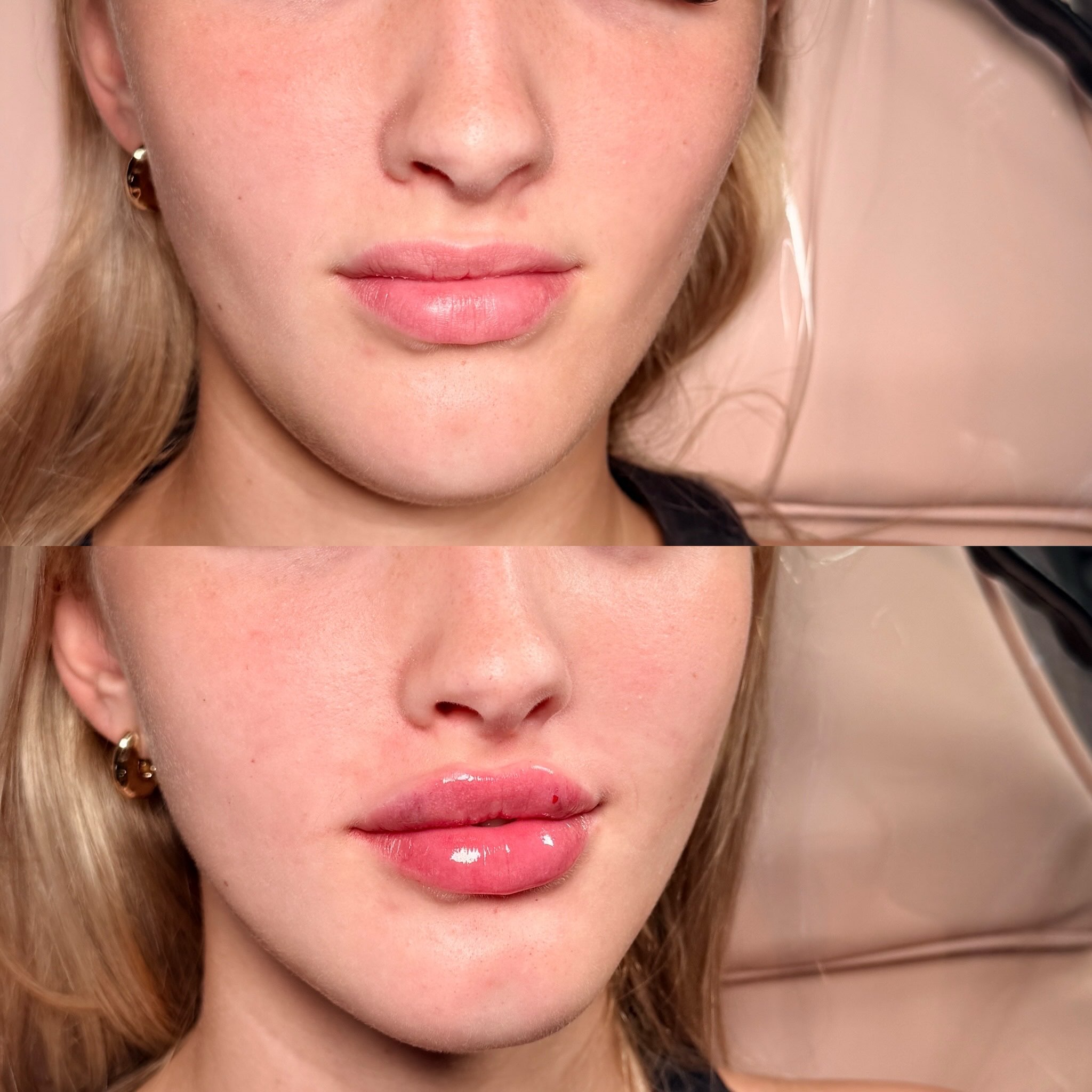 
Subtle lip enhancement ✨
A beautiful example of how lip filler can be used to gently improve lip symmetry and balance, whilst keeping the result soft and natural.
A small amount of filler can make such a difference 🤍
__________________________
Thinking about aesthetic treatments?
Book your FREE consultation today 💫
📲 07517416782
📧 hello@archedaesthetics.co.uk
🌐 www.archedaesthetics.co.uk
⭐ 5 Star reviews
🎁 Gift vouchers available
DM to book