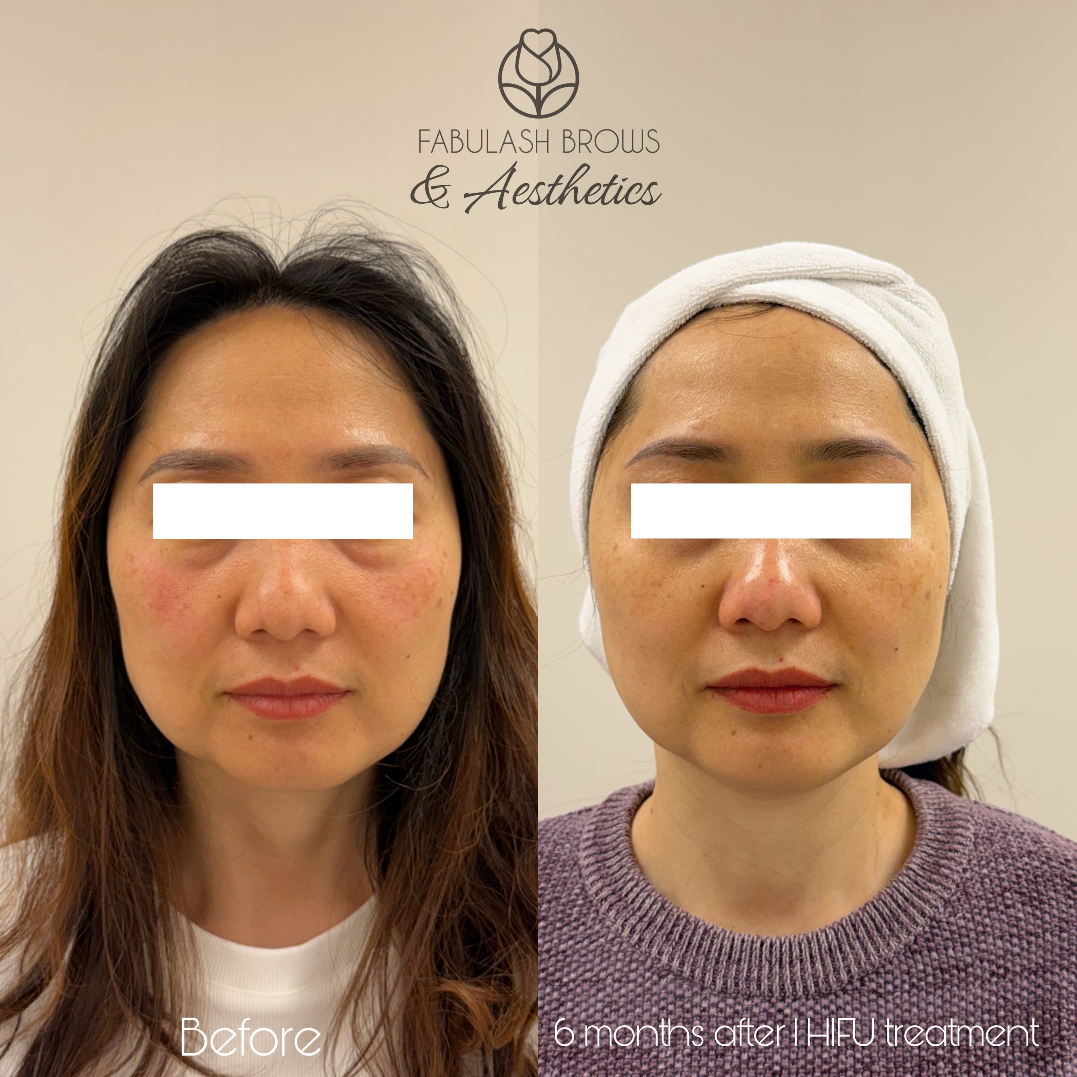 💁♀️ She is back after 6 month having HIFU treatment ! Our client from Wanganui 😊!
#hifufacelifting #skintightening #wellington #advanceskintreatment #wellingtonskinclinic
