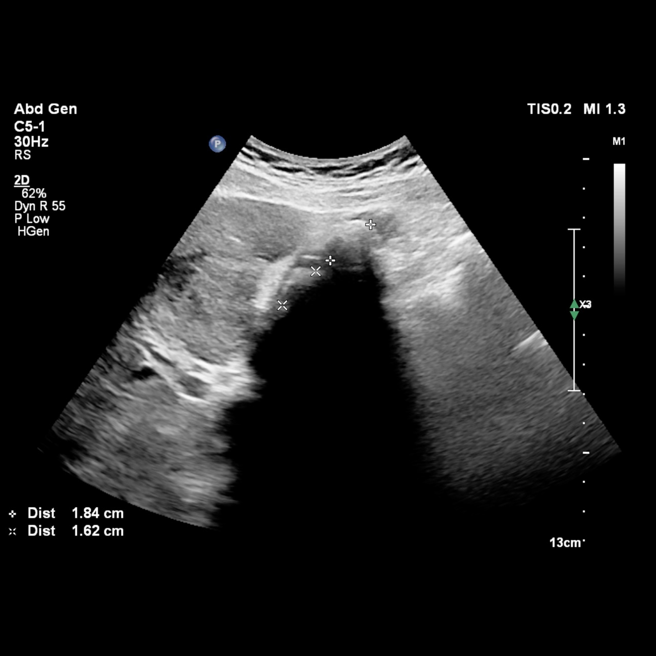 An enlarged, heterogenous liver with numerous parenchymal focal lesions and surface lobularity — highly suspicious for metastatic liver disease. At least two gallstones were noted in the gallbladder. The common duct is not dilated.
Getting the report structure right on a case like this is exactly what we'll work through in our Fellowship Exam webinar, Aug 20 — link in bio.
#POCUS #PointOfCareUltrasound #EmergencyMedicine #Ultrasound #FOAMed