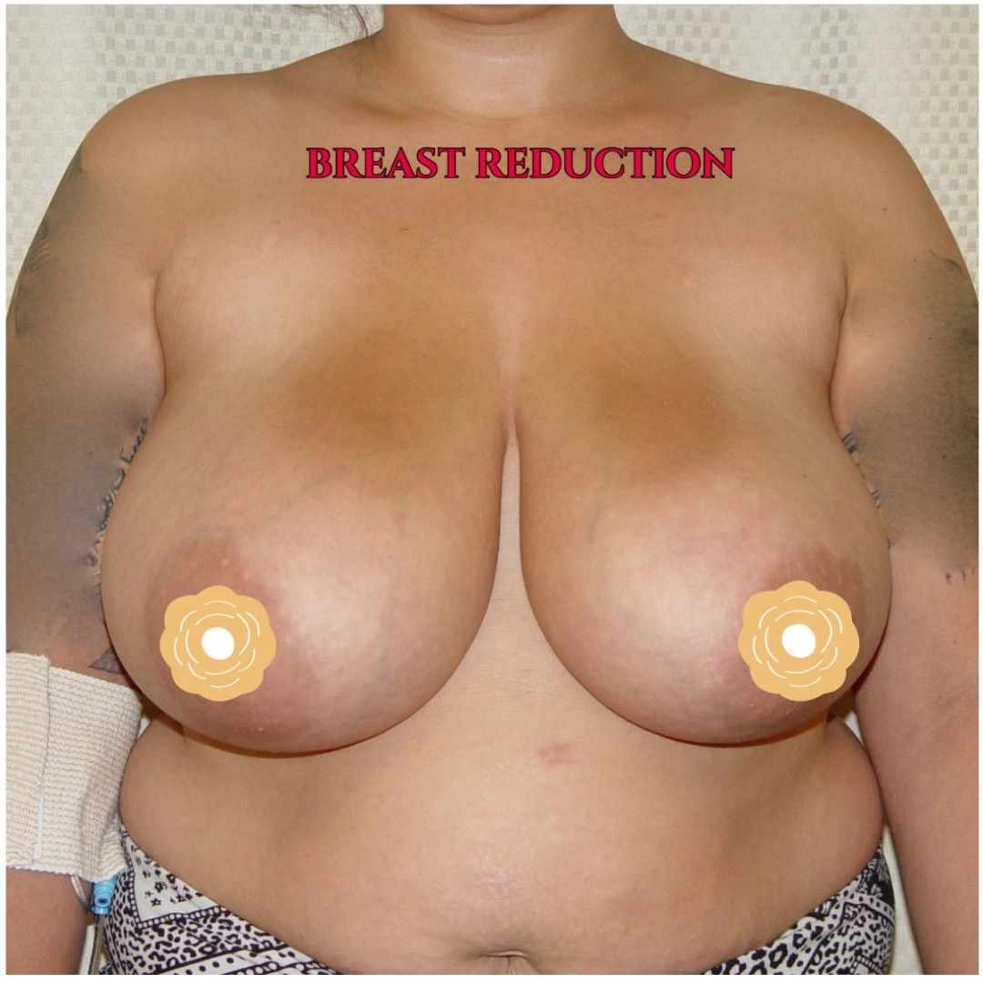BREAST REDUCTION - Extremely large, saggy breasts cause physical symptoms like neck pain, shoulder pain, back pain, headaches, bra strap grooves in the shoulders, and rashes under the breasts. If you have these symptoms, then breast reduction immediately relieves the symptoms. Breast reduction also includes breast lift. Call us now at 714-500-0050 for a consultation. #drluudoan #bellabeachbod #breastreduction #breastlift #mastopexy #OCplasticsurgery #OCcosmeticsurgery #LAplasticsurgery