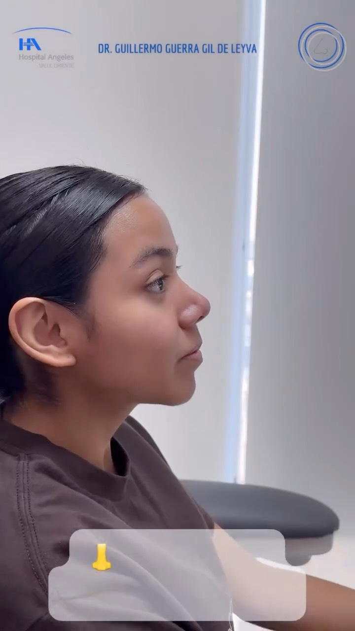 🔹 Tu satisfacción es nuestra prioridad. Cada Rinoplastia es diseñada para ti, considerando tus facciones y deseos.
🔹Evolución a dos meses de Cirugía Nasal Estética y Funcional.
🔹 Gracias a mi excelente paciente por su confianza y permitir compartir su resultado.
🔹”Made by hand. Crafted with passion”
🧑⚕️ Dr. Guillermo Guerra Gil de Leyva
🏥 Hospital Ángeles Valle Oriente
📱 81-1252-0132
🎓Universidad de Monterrey
👃 Rinoplastia Estética y Funcional
🚫 No taponamiento
Cédula Profesional: 3070499
Cédula Especialista: 4503273
No. Certificación CONACEM: GUG-1748/04
Aviso de Publicidad COFEPRIS: 2419032002A00111
❕Paciente autoriza difusión de imágenes con fines académicos e informativos.
❕Los resultados finales se pudieran observar hasta un año de la cirugía y dependerá tanto del compromiso del cirujano como del paciente, así como del tipo de cirugía, tipo de piel, cuidados post-operatorios, etc.
#RinoplastiaPersonalizada #TuNarizTuEstilo
#rinoplastia #rhinoplasty #nosejob septoplasty rinoseptumplastia rhinoseptoplasty nosejob nose nosesurgery tabiquenasal otorrinolaringologia entsurgery cirugianasal cirugiatabique cirugiaesteticanasal
belleza confianza autoestima
cosmeticsurgery
otorrinolaringologiamonterrey otorrinomonterrey beforeandafter antesydespues
estructuredrhinoplasty
rinoplastiaestructurada
rinoplastiaultrasonica
ultrasonicrhinoplasty