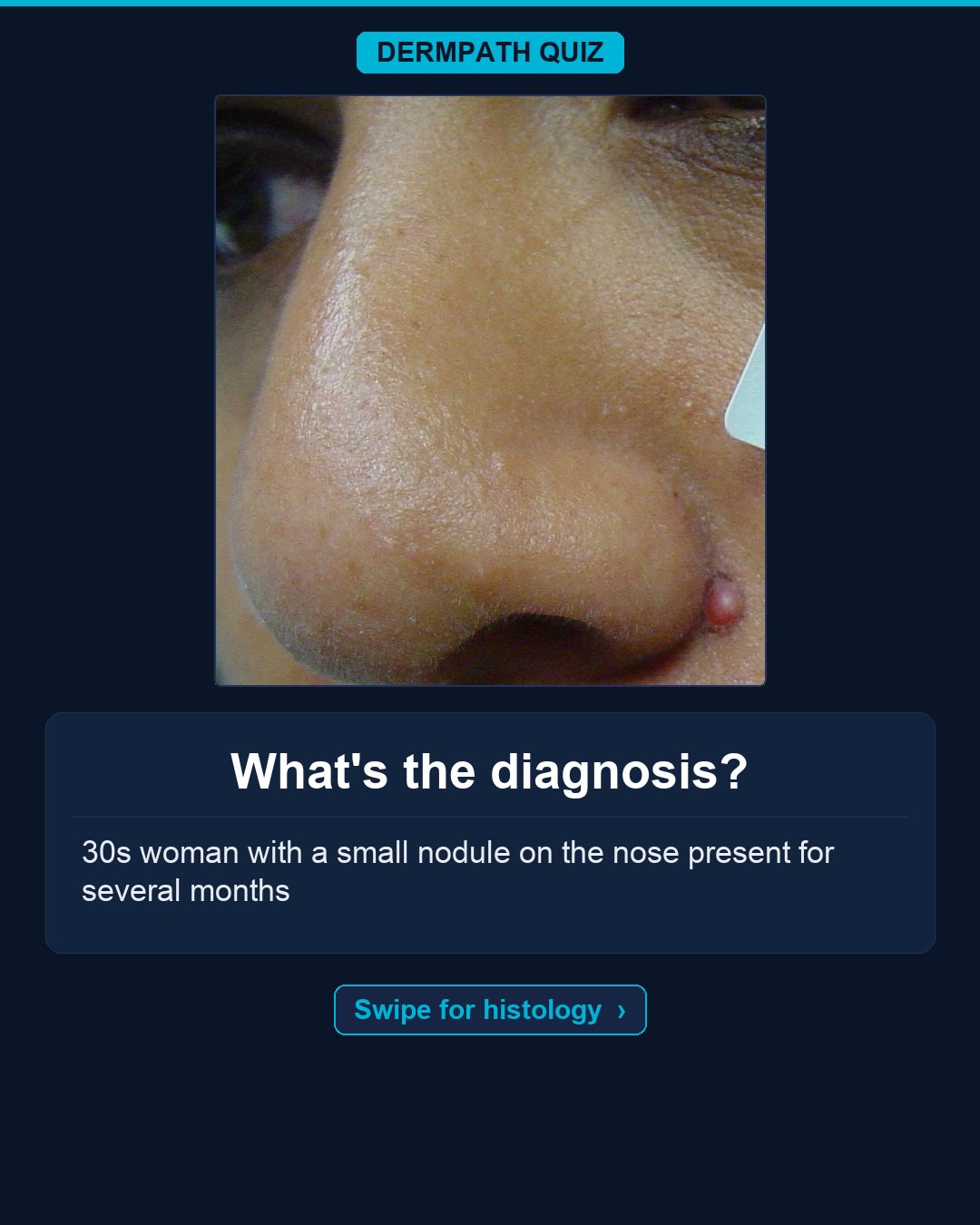 🔬 What’s the diagnosis?
The case: 30yo woman with a small nodule on the nose present for several months.
Study the clinical photo and the histology, then make your call. Keep swiping for the diagnosis, the labeled slides, and the high-yield pearls.
Your diagnosis? Drop it in the comments before you swipe to the answer 👇
Save this for board review and tag someone who would nail it. Follow for a new dermatopathology case every week.