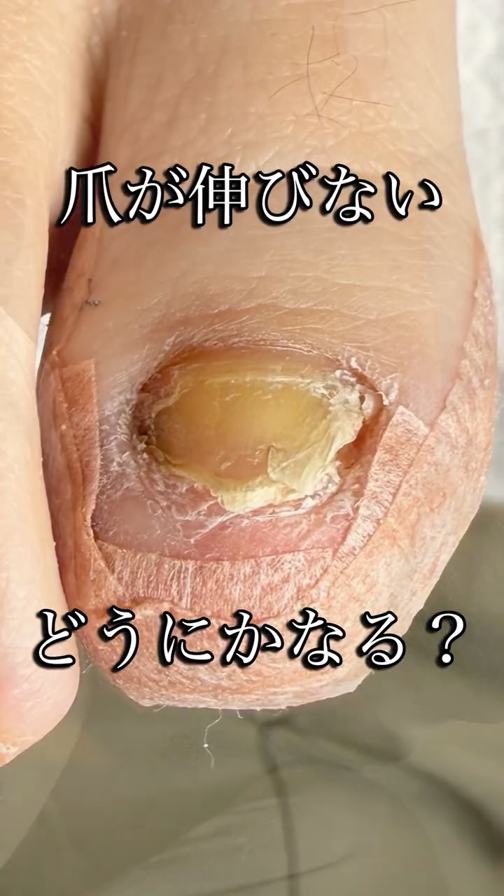 爪が伸びないとのお悩み
とても多いです
爪の伸びを邪魔する詰まりを
しっかりお掃除することで
健やかな爪を育てる
お手伝いをします◎
2回目以降は
伸びるスピードや
伸び方のクセは人それぞれ
その方の爪の成長を見ながら
ケアします
写真を撮って比べるので
ご自身では気づかなかった
爪の変化が見えます👀
初回はドキドキされると思います。
お爪はなーんにもせずに
お悩みと共にご来店くだされば
大丈夫です◎
安心してご帰宅できるように
全力でご説明&施術いたします😊
────────────
habitsフットケアスタジオ
🏠横浜市青葉区青葉台1-24-1-103
📞080-3092-4207
営業時間 9:00~18:00
定休日 日曜・水曜
────────────