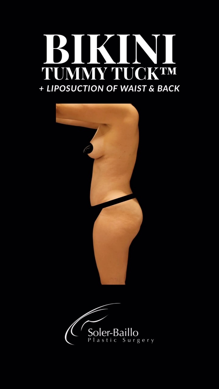 👙 Meet the Bikini Tummy Tuck™ by Dr. Soler-Baillo.
A signature approach designed to sculpt, tighten, and refine the entire midsection while keeping the scar beautifully hidden within the bikini line. 🤍
The Bikini Tummy Tuck™ incorporates:
• Bella Button™ for a natural-looking belly button
• A low, discreet scar designed to stay hidden beneath your bikini
• Liposuction of the waist & back for a more sculpted silhouette
Because a tummy tuck shouldn’t just flatten the abdomen. It should reshape the entire figure. ✨
Ready for your transformation? DM us to schedule your consultation.
#BikiniTummyTuck #BikiniTummyTuckTM #BellaButton #TummyTuck #Abdominoplasty