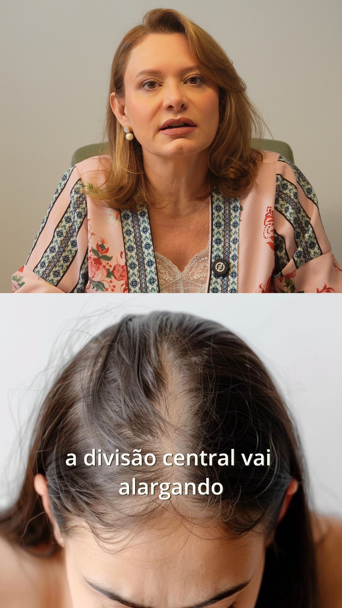 A calvície feminina é mais comum do que parece — e quase sempre acontece em silêncio.
O processo é diferente do masculino: não forma uma área careca, mas vai reduzindo o volume e alargando a divisão central aos poucos. E o impacto emocional é enorme.
Isso tem diagnóstico e tem tratamento. Link na bio. 💚
Dra. Vanessa Mutton
CRM 80450 | RQE 20280
#dravanessamutton #calviciefeminina