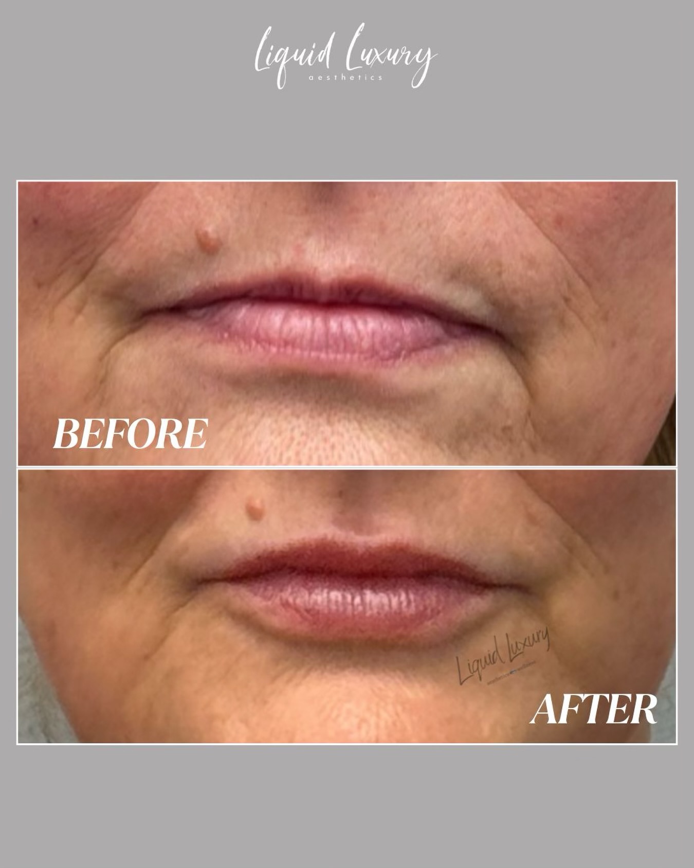 This treatment used Evolysse Smooth to subtly enhance the lips while also improving the downturn at the corners of the mouth.
The goal is always soft, balanced results that complement your natural features, not change them.
๐ (631) 760-1124
๐ www.liquidluxuryaesthetics.com
๐ 1030 W Jericho Tpke Suite 5 Smithtown, NY 11787
๐ง info@liquidluxuryaesthetics.com
๐ฉ๐ผโโ๏ธ Ina LaRocca-Tocco, FNP-C
๐คณ TikTok: liquidluxury_aesthetics
#LipFiller #Evolysse #MedicalAesthetics #LongIslandMedSpa #NaturalResults