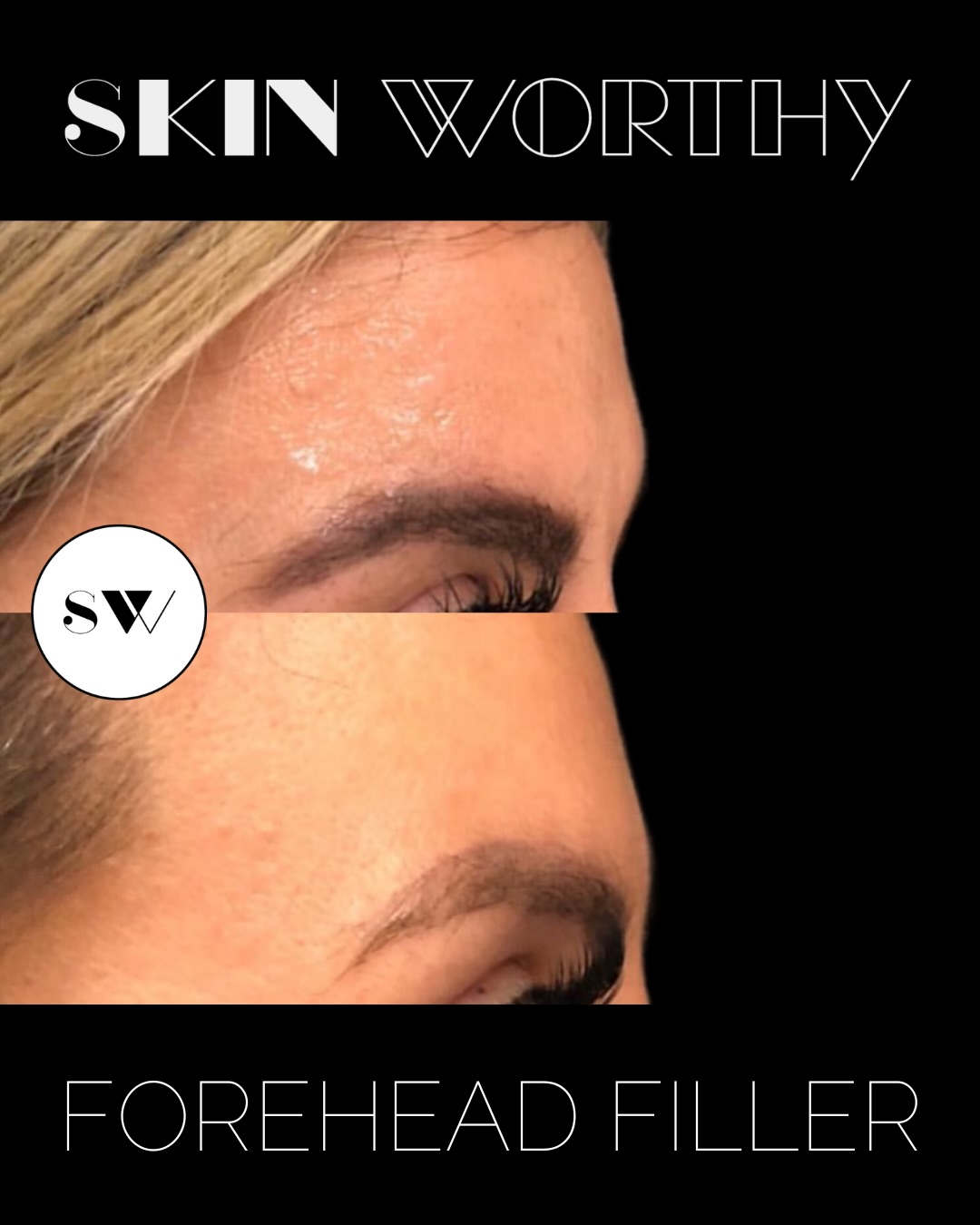 Most people think of anti-wrinkle injections when they think about treating the forehead, but movement isn’t always the only thing affecting how smooth the forehead looks.
Aging, exercise and weight loss can all contribute to subtle volume changes in the forehead. These changes can create small dips or depressions that become more noticeable as light reflects across the face. In these cases, simply relaxing the muscle may not consistently create the smooth, even result we’re looking for.
For this patient, we had been using Nuceiva injections to relax the forehead, but there were still areas of uneven contour. By strategically placing a soft, thin dermal filler, we were able to restore volume, improve hydration and create a smoother, more youthful forehead contour.
Forehead filler is not a replacement for anti-wrinkle injections, but in the right patient, the two treatments can complement one another beautifully. Improving the underlying contour may also mean less toxin is required over time, while reducing muscle movement can help preserve the filler result.
The forehead is a higher-risk injection area, so filler is not a first-line treatment for horizontal forehead lines. However, when volume loss or contour irregularities are contributing to the appearance of the forehead, carefully placed filler can make a significant difference.
Interested in learning more about transition zones, injectables, or starting your own Beauty Evolution?
Call/text 647-350-7546 or send us a DM