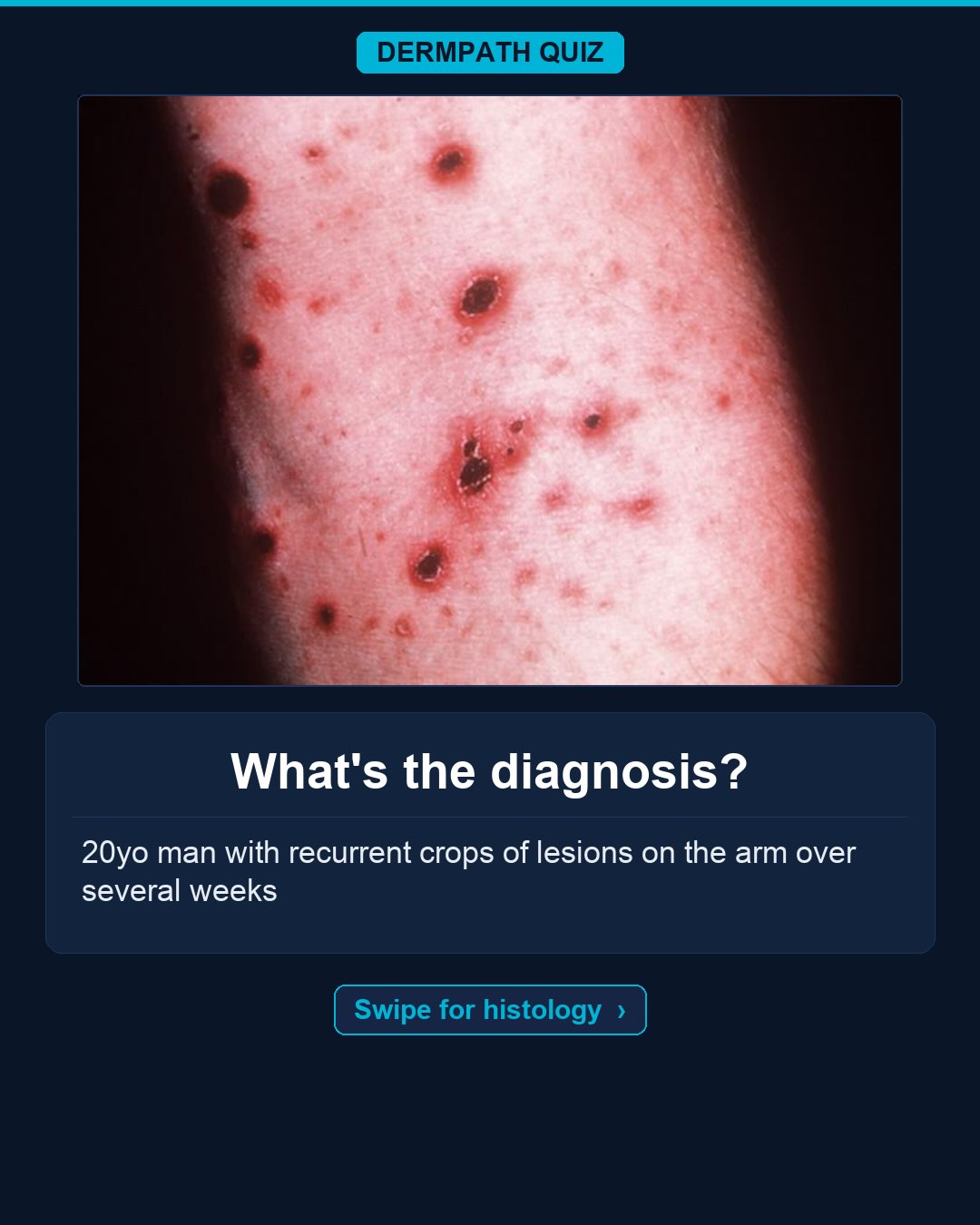 🔬 What’s the diagnosis?
The case: 20yo man with recurrent lesions on the arm over several weeks.
Study the clinical photo and the histology, then make your call. Keep swiping for the diagnosis, the labeled slides, and the high-yield pearls.
Your diagnosis? Drop it in the comments before you swipe to the answer 👇
Save this for board review and tag someone who would nail it. Follow for a new dermatopathology case every week.