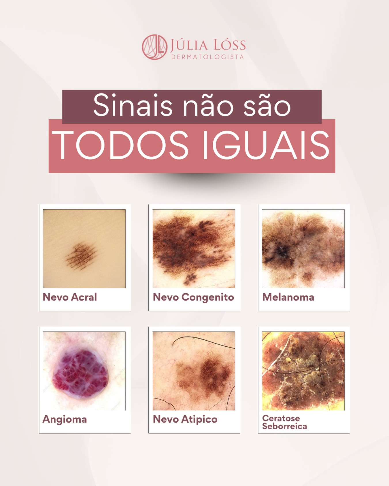 Algumas são benignas e fazem parte da história natural da pele.
Outras precisam de acompanhamento periódico.
E algumas exigem diagnóstico e tratamento precoces.
O grande desafio é que essas diferenças nem sempre são perceptíveis a olho nu. É justamente por isso que a avaliação especializada é tão importante.
Na dermatologia, a conduta não é definida apenas pelo aspecto da lesão, mas pela associação entre a história clínica, o exame físico e recursos como a dermatoscopia, que permitem uma análise muito mais precisa.
Dra. Júlia Lóss - Médica Dermatologista Oncológica
CRM 5201085638 RQE 34041
#DermatologiaOncologica #DermatologistaNiteroiRJ #DermatologiaNiteroi #cancerdepele #pintas