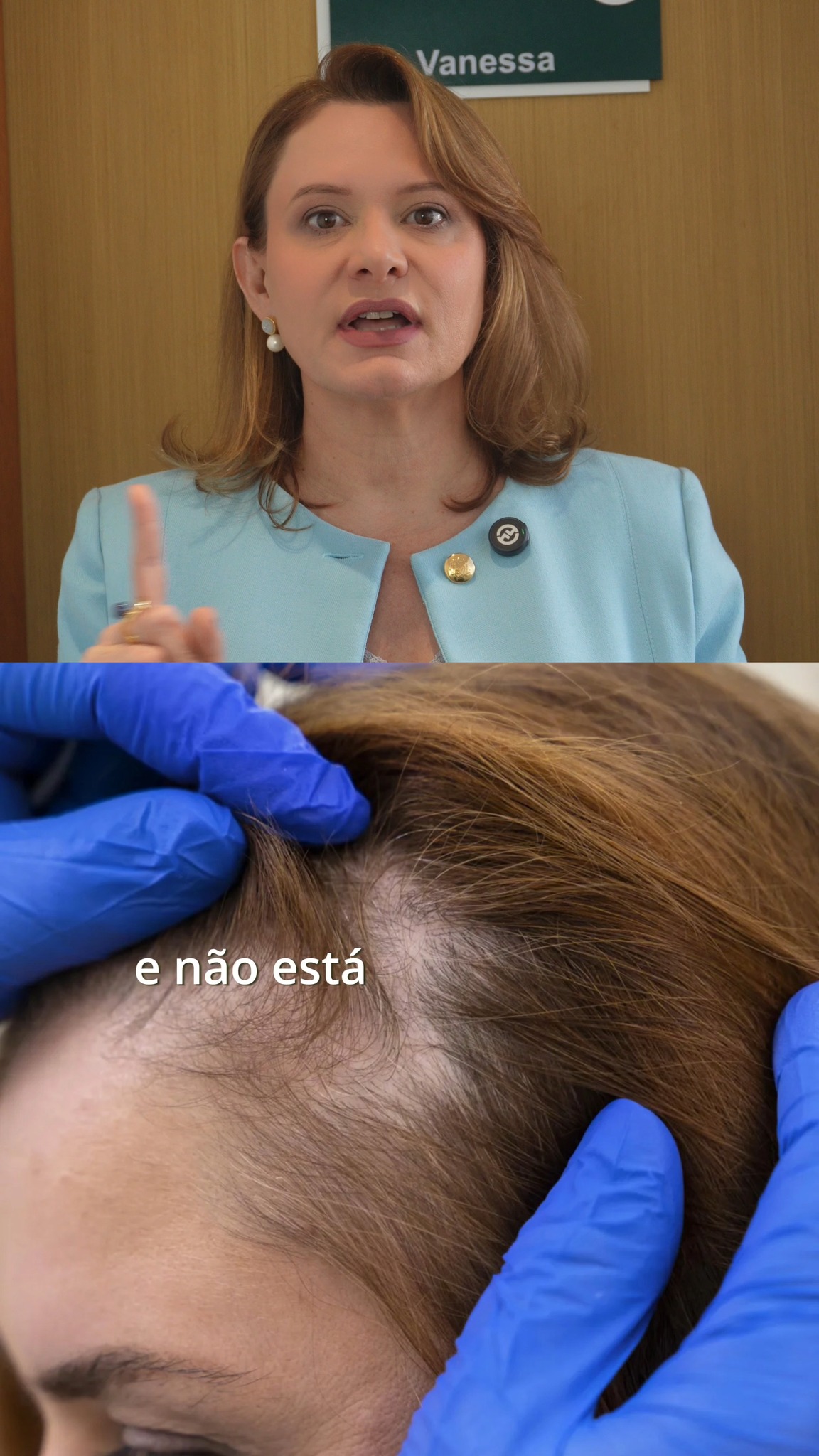 Uma mancha redonda no couro cabeludo que apareceu do nada não é calvície comum — pode ser alopecia areata, uma doença autoimune.
O tratamento é completamente diferente, e só o diagnóstico correto define o caminho certo para cada caso.
Notou algo assim? Não ignore. Link na bio. 👀
Dra. Vanessa Mutton
CRM 80450 | RQE 20280
#dravanessamutton #alopeciaareata #quedadecabelo