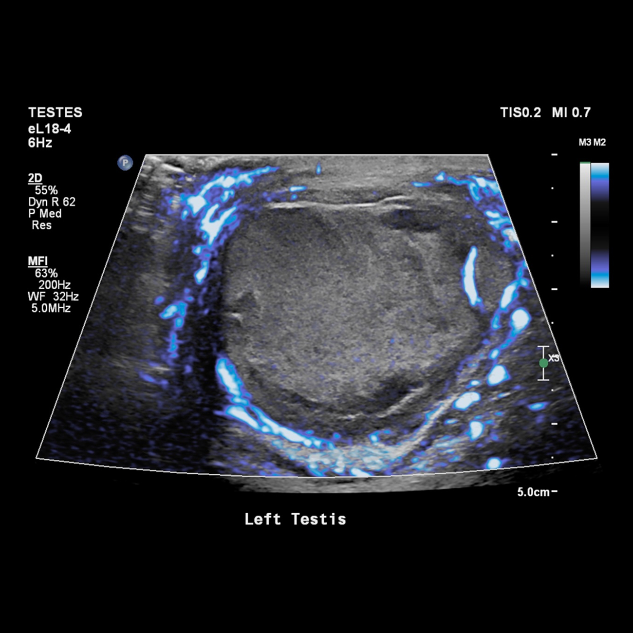 A 49 year old man re-presents two days after hernia repair with scrotal swelling and pain. What’s your diagnosis?
Answer posted in a few days ahead of our Fellowship Exam Webinar.
#POCUS #PointOfCareUltrasound #EmergencyMedicine #Ultrasound #FOAMed