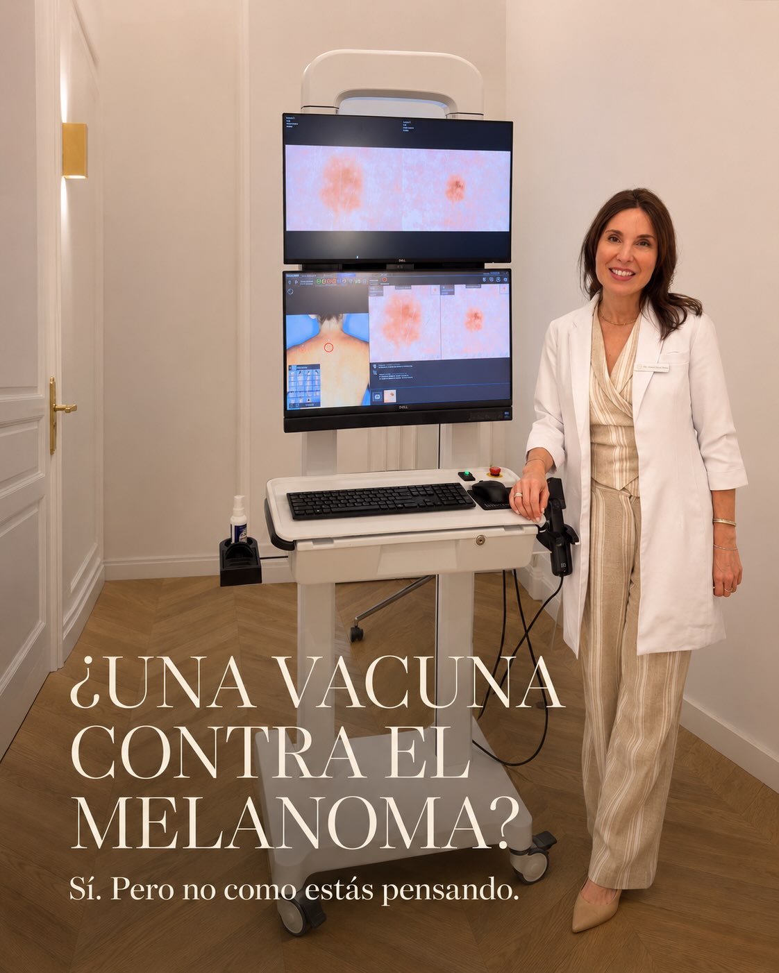 Una vacuna contra el melanoma? Sí, pero con matices.
Lo que se está investigando no es una vacuna preventiva, sino una terapia individualizada de neoantígenos basada en ARNm para pacientes con melanoma.
Se analiza el tumor de cada paciente, se identifican mutaciones capaces de generar neoantígenos y se diseña una terapia personalizada que se administra junto a pembrolizumab, una inmunoterapia anti-PD-1.
En el ensayo fase IIb KEYNOTE-942, con 157 pacientes, la combinación mostró a unos 5 años:
49 % menos riesgo relativo de recaída o muerte
59 % menos riesgo relativo de metástasis a distancia o muerte frente a pembrolizumab solo.
Son resultados muy prometedores, pero la terapia sigue siendo experimental
Y algo importante: estos avances no cambian la prevención. La radiación ultravioleta sigue siendo un factor causal del melanoma.
La ciencia está cambiando cómo tratamos esta enfermedad.
Pero prevenir y diagnosticar precozmente siguen siendo fundamentales y nuestra primera opción
#melanoma
#vacunamelanoma
#investigacion
#dermatologiaclinica