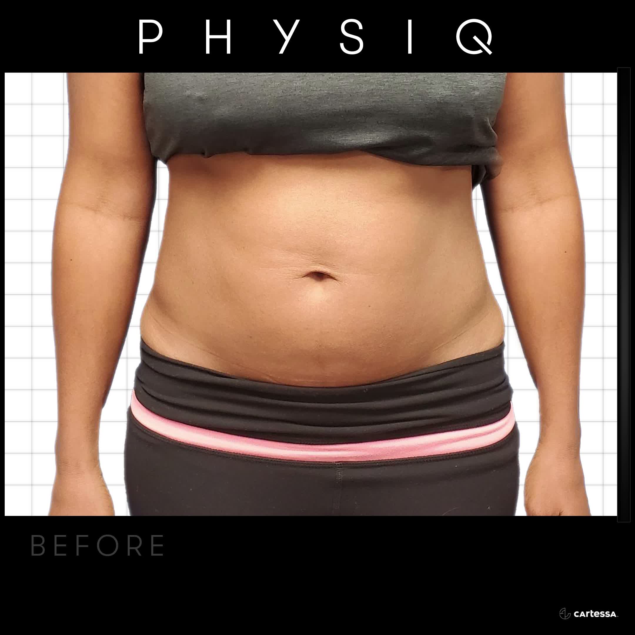 Have you been eating clean and staying active but still can't shake that stubborn belly or arm fat? We can't control where we store fat on our body and no matter how hard we try--- some areas can't be "tamed" like we want them to be.
PhysiQ Body Contouring at Vitality Wellness Med Spa Fort Worth was built for exactly that frustration. Our Doctor/Nurse Duo, Dr. Julie and Sherry, will walk you through exactly what to expect, take "before and after" pictures and help you work those trouble areas.
๐๐๐๐ ๐๐๐๐:
https://vitalitywellness.myaestheticrecord.com/online-booking
Call 682-233-6131 and let's talk about what PhysiQ can change for you!
#PhysiQBodyContouring #FortWorthWellness #BodyContouringResults #VitalityMedSpa #FortWorthTexas #PhysiQ