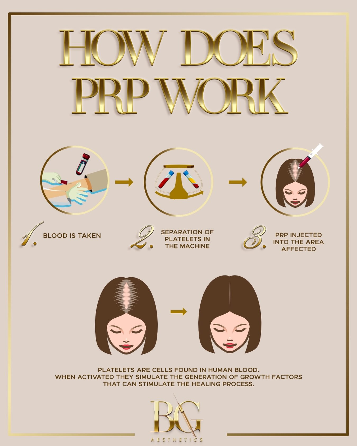 ✨ PRP — using your own blood to support healthier skin & hair ✨
PRP (Platelet-Rich Plasma) starts with a small amount of your own blood. 🩸
The blood is placed into a centrifuge and spun at a specific speed to separate the different components. This allows us to isolate the platelet-rich plasma, which contains a concentrated amount of platelets and growth factors.
Once separated, the PRP can be used in different ways depending on the treatment area and desired result.
💉 PRP for hair
Injected into the scalp, PRP delivers growth factors directly to the area, helping to support the hair follicles, improve the condition of the scalp and encourage healthier-looking, stronger hair growth.
✨ PRP for skin
Injected into the skin, PRP can support collagen and elastin production, improve skin texture and elasticity, and encourage a fresher, more rejuvenated appearance. It can be particularly lovely for improving overall skin quality rather than simply adding volume.
🪡 PRP can also be microneedled
Instead of injecting the PRP directly into the skin, it can be applied topically during microneedling. The tiny channels created by the needles allow the PRP to penetrate into the skin while also stimulating the skin’s natural repair process.
Because PRP uses your own blood, it is a completely personalised treatment designed to work with your body’s own natural regenerative processes. 🤍
Results develop gradually as the skin and hair respond and regenerate — this is about skin and hair health, not an overnight fix.
📲 Book online at www.bgaesthetics.co.uk
🌸 Pay in 3 with Klarna
#PRP #PRPTreatment #vampirefacial #prphairrestoration #aestheticstreatments