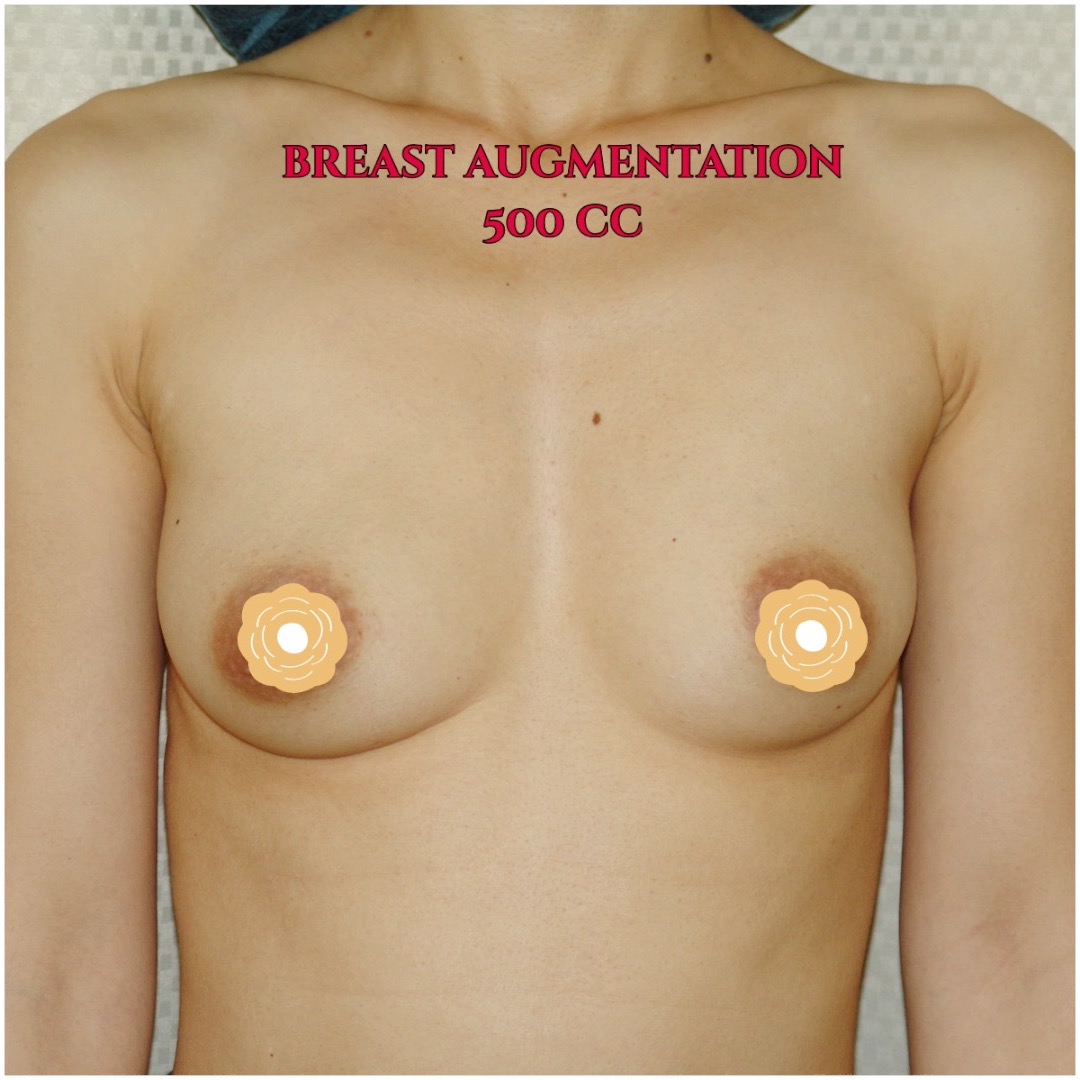 Call now for our Mid-Summer Specials! Saline Breast Aug -->$3995 Silicone Breast Aug --> $6495 Tummy Tuck starts at --> $7995. Call (714) 500-0050 #drluudoan #breastaug #salineimplants #siliconegelimplants #tummytuck #abdominoplasty