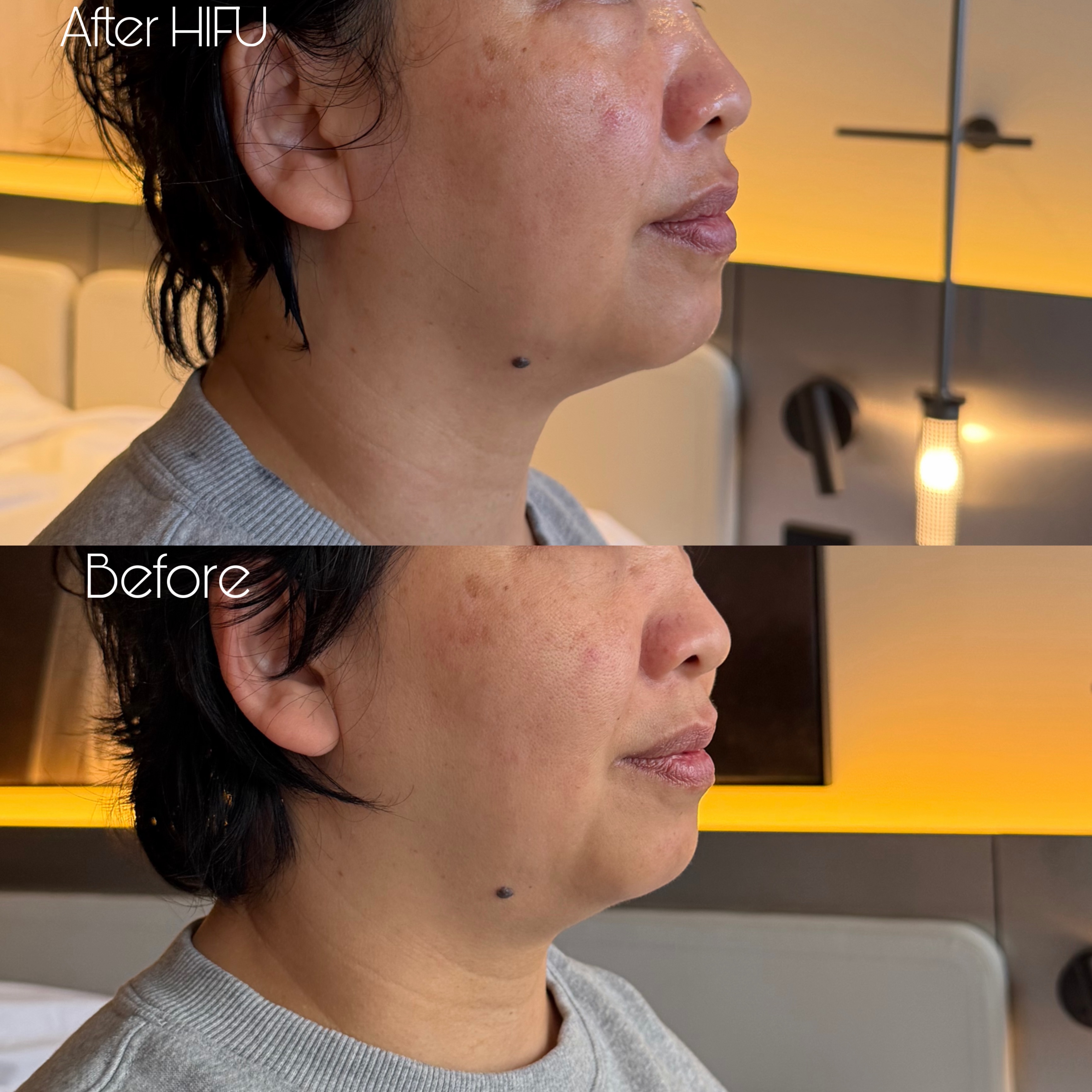 #faceandnecklift using #nanozellehifutreatment
The result will be more improved in the next 3 months #skintightening #hifutreatment #facelifting
💁♀️Book online for free consultation 👇
Www.fabulashbrows.co.nz