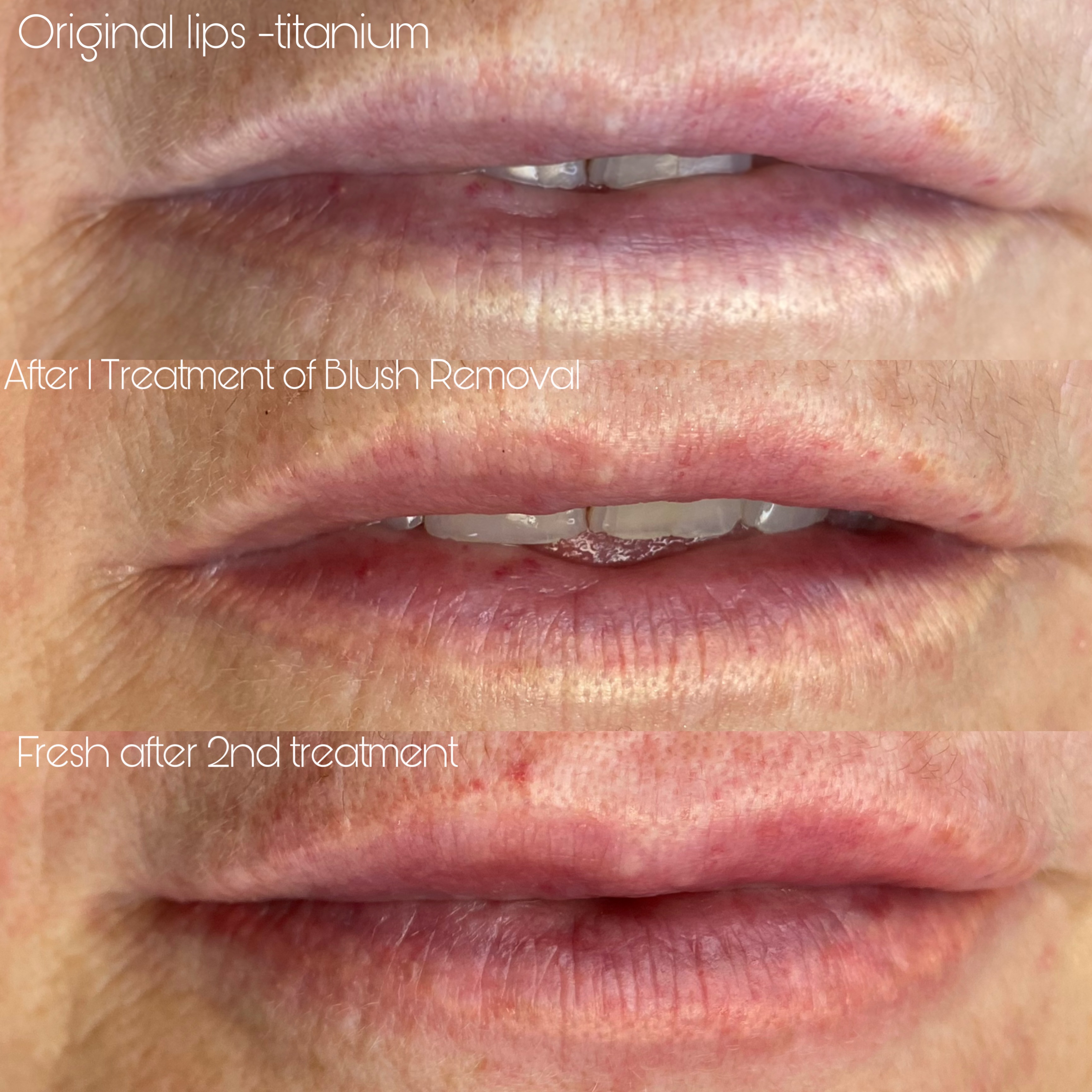 💁♀️if you have old tattooed lips, want to get removed and then redo New color new shape?
📲 Contact us for free consultation and plan
We have all solutions in hand to help you😊💯!
#liptattoocorrection #wellington #cosmetictattoo #blushlips #liptattoo