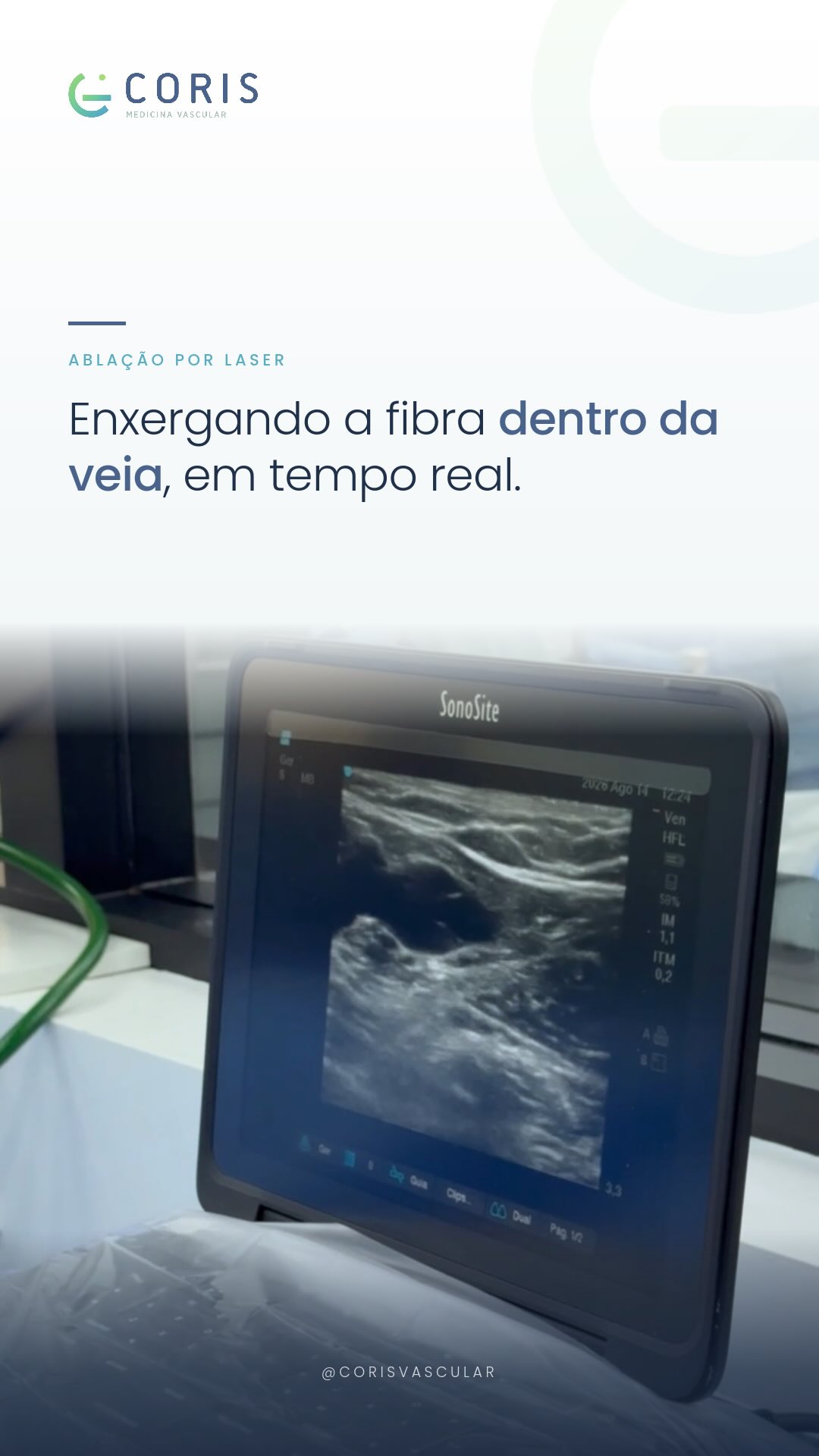 Por dentro da veia safena, em tempo real.
O ultrassom mostra onde a fibra está antes da ablação. É esse controle que permite tratar a veia doente com precisão e segurança.