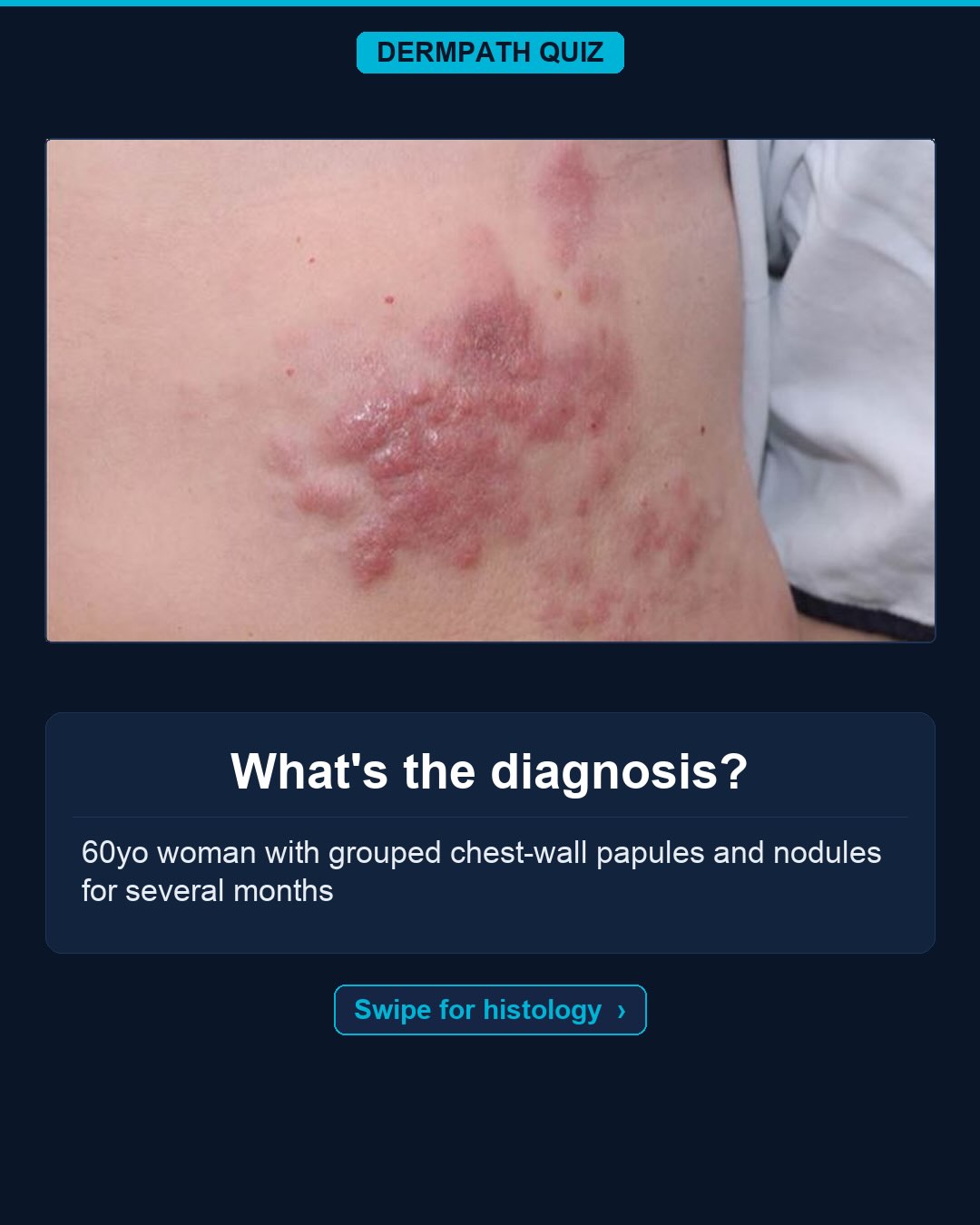 🔬 What’s the diagnosis?
The case: 60yo woman with grouped chest-wall papules and nodules for several months.
Study the clinical photo and the histology, then make your call. Keep swiping for the diagnosis, the labeled slides, and the high-yield pearls.
Your diagnosis? Drop it in the comments before you swipe to the answer 👇
Save this for board review and tag someone who would nail it. Follow for a new dermatopathology case every week.