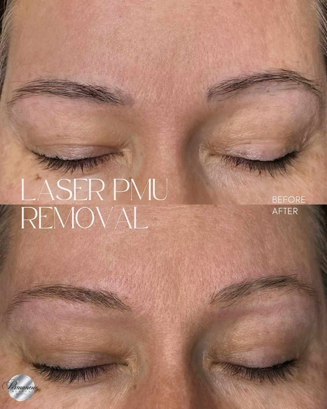 This client came to me with old brow tattoo that had faded unevenly over time. Instead of waiting years for it to fade further, I removed the remaining pigment with just one laser session.
As a result, she got visibly lighter brows, a more natural appearance, and a clean base for the next step: whether she’ll choose to keep her natural brows or create a new look with fresh and natural permanent makeup.
If you have old PMU you’re ready to let go of, book the appointment. I’ll assess the pigment and recommend the best approach for your case 🤍
Permanent Makeup Services,
Tattoo Removal & Carbon Laser Facial
⬆️Book apt with the link in bio
✨Free Consultation available
📍Oshawa, Ontario
✉️browsbyieva@gmail.com
☎️416-804-6749
Website:
permanentbeautybyieva.com
#evolaser#tattooremovaloshawa#laserremovaltattoo#whitbytattooremoval#ajaxtattooremoval