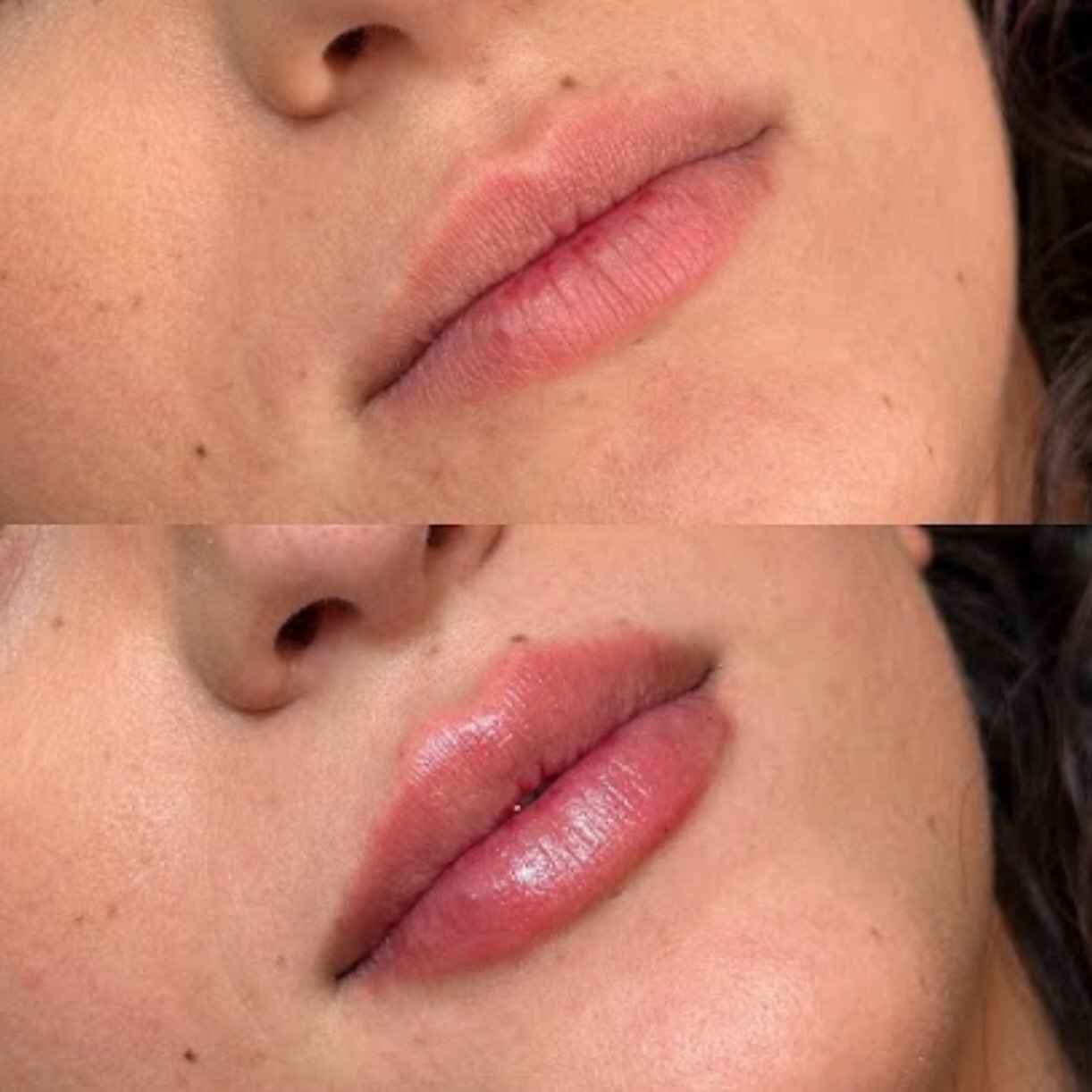 What providers don’t come right out and tell you about lip filler is that you may not get the lips you WANT, and it’s not about the product, the technique or the price point. If what you want and what your natural anatomy is capable of don’t align, then it’s not going to happen.
Does that mean you cant get enhancement? Absolutely not. But thin and tight lips will never look full and pouty, so it’s about getting the enhancement that works for your aesthetic goals and aligns with the natural limitations of your anatomy.
Testing that limitation as both an injector and a patient means unsatisfactory outcomes and the dreaded migration. Respecting the boundaries of the lips, the capacity and of course choosing the right products, technique and most importantly, injector- is always going to tee you up for the best outcome.
Total product: .7ml using a hydrid technique for shape and volume. Ready for your own transformation? Comment “READY” to get started.