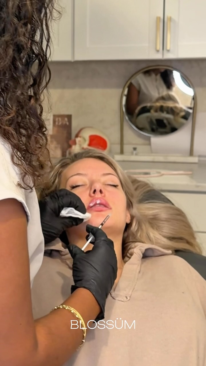 #lipfillerraleigh #medsparaleigh #lipfillercharlotte #lipfillergreensboro