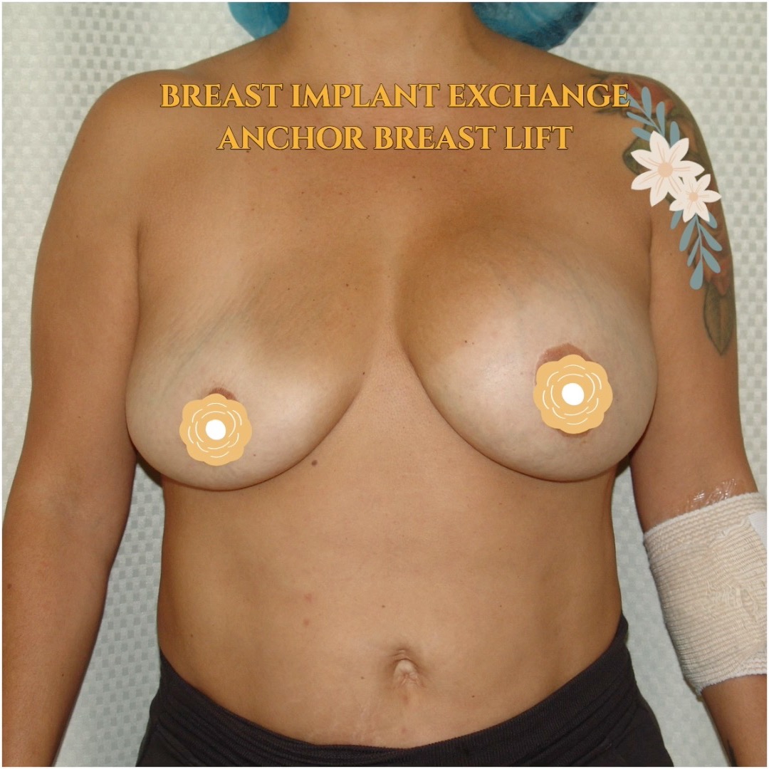 This woman has a deflation of her right implant. She wanted smaller implants and breast lift. I changed out her implants from 450 cc to 225 cc and performed anchor breast lift. Call now for our Mid-Summer Specials! Saline Breast Aug -->$3995 Silicone Breast Aug --> $6495 Tummy Tuck starts at --> $7995. Call (714) 500-0050 #drluudoan #breastaug #salineimplants #siliconegelimplants #tummytuck #abdominoplasty