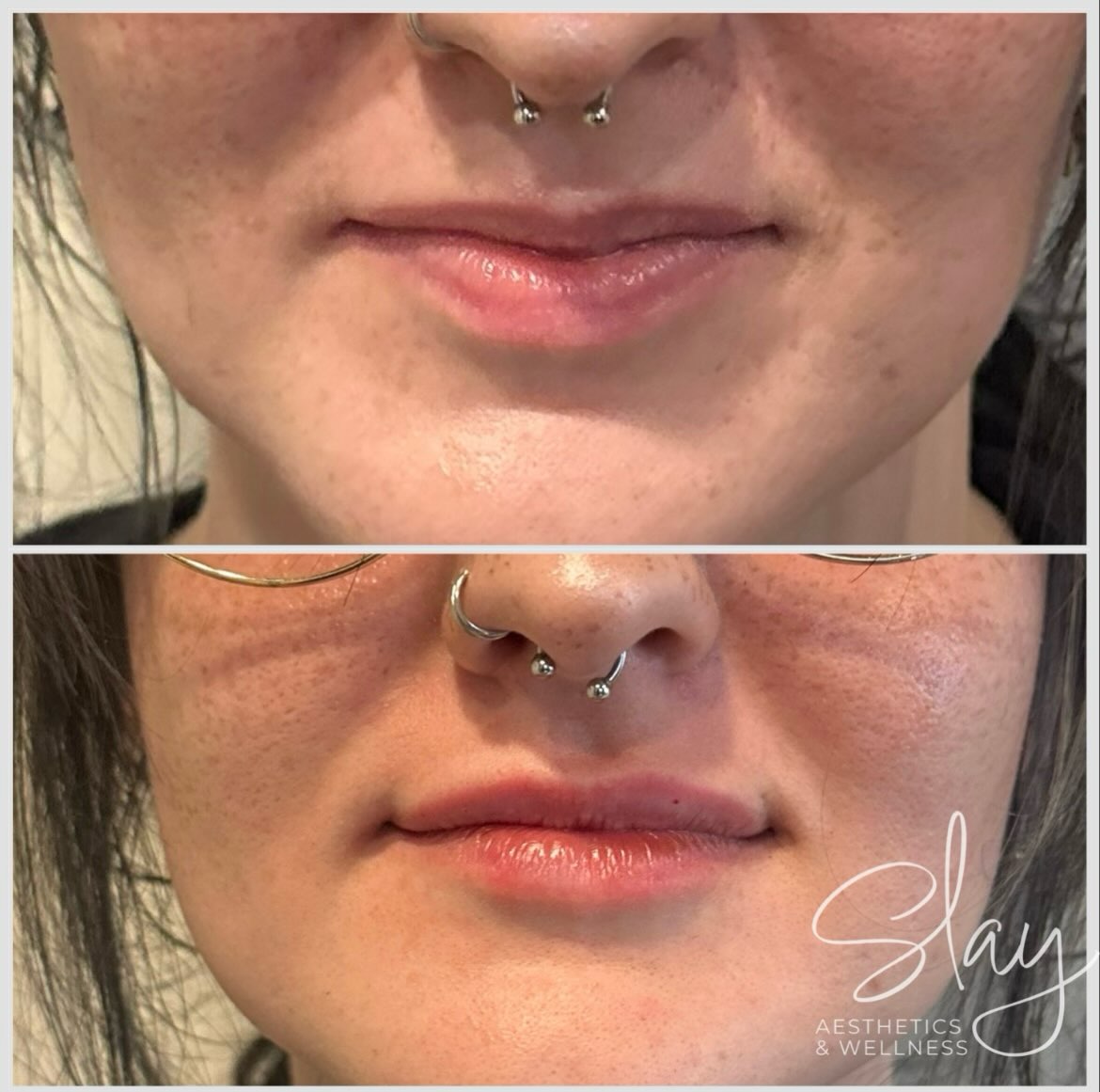 ✨ MINI PLUMP. MAXIMUM IMPACT. ✨
This before & after shows what just ½ syringe of filler can do when the goal is soft, natural-looking enhancement. 💋
A Mini Plump is perfect for someone who wants to:
• Add a little hydration and volume
• Enhance lip shape and definition
• Create subtle balance without an overfilled look
• Ease into lip filler with a conservative approach
At Slay Aesthetics & Wellness, treatments are customized to your features and your goals—because beautiful results should still look like you. 🤍
Ready for your own Mini Plump?
✨ Book your appointment:
https://slay-aesthetics.janeapp.com/
✨ Learn more:
https://slay-aesthetics.com
✨ Cherry payment plans:
https://www.slay-aesthetics.com/payment-plans
#SlayAesthetics #LipFiller #miniplump #newarkohio #bellezzasalon