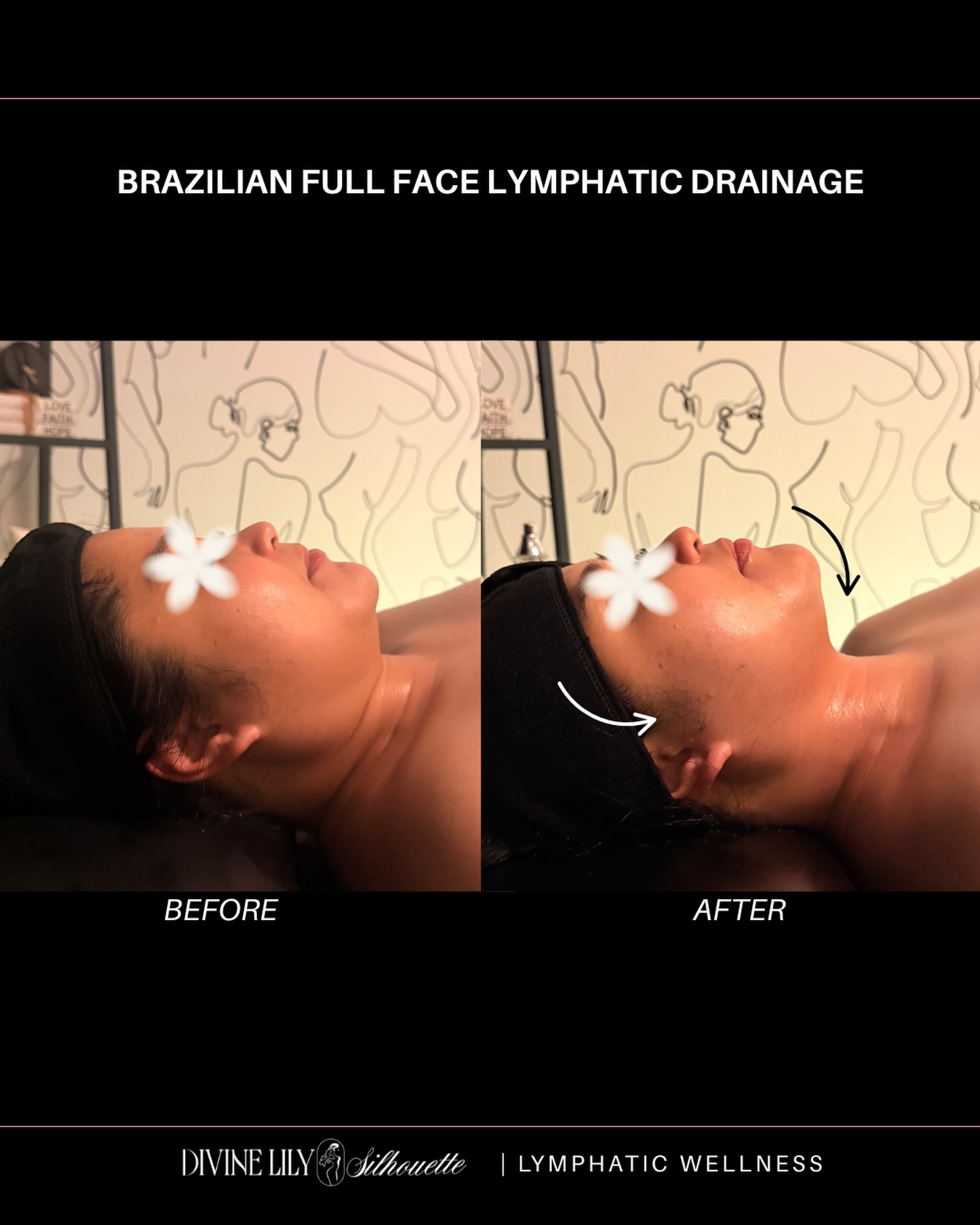 Sometimes the puffiness we see in our face isn’t just swelling, our bodies can hold onto extra fluid from stress, lack of sleep, lifestyle, and even where we are in our menstrual cycle.
A full face lymphatic drainage session helps encourage healthy lymph flow and move that stagnant fluid, which is why you can already see a beautiful difference right after one session. And in the days following, you may continue to notice your face feeling lighter, less puffy, and more refreshed.
Lymphatic drainage is a wellness practice to incorporate into your self care routine when your body is asking for a little extra support. ✨
BOOK | SHOP | TRAIN WITH ME
📍 Airdrie, Alberta Canada
📧 info@divinelilysilhouette.com
🔗 www.divinelilysilhouette.com
🎓MASTERCLASS: Register Now
.
.
#yyc #yycbeauty #brazilianlymphaticdrainagecalgary #yycaesthetics