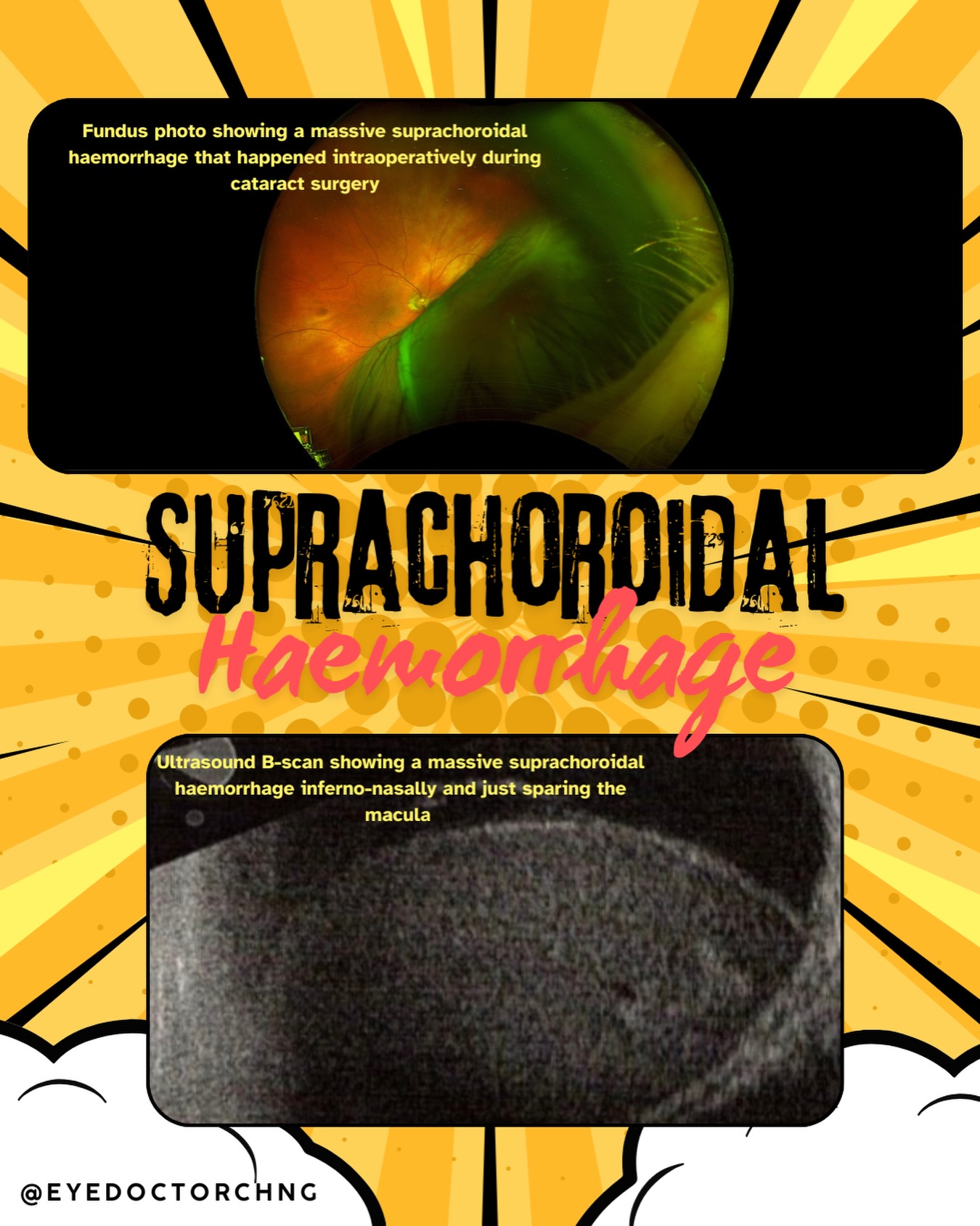 SUPRACHOROIDAL HAEMORRHAGE
What is it?
Bleeding into the suprachoroidal space which is the potential space between the choroid and sclera at the back of the eye. This is a rare but one of the most feared complications in eye surgery because it can threaten vision.
When does it happen?
• During or after eye surgery (cataract, glaucoma, vitrectomy)
• After trauma
• Spontaneously (no clear cause)
Intraoperative warning signs?
• Sudden severe pain
• Loss of the red reflex
• Rising eye pressure
• Shallowing anterior chamber
• Iris/tissue prolapse
Whenever you suspect suprachoroidal haemorrhage, Immediate wound closure is critical.
Who’s at higher risk?
• Older age
• High blood pressure
• Glaucoma & high myopia
• Blood thinners (anticoagulants/antiplatelets)
• Retinal detachment, previous surgery or ocular hypotony
How is it managed?
• Some cases: watch & wait with pressure/pain control
• Larger/appositional bleeds: surgical drainage ± vitrectomy
When to drain?
First rule is DON’T drain immediately because immediate drainage during an active bleed makes things worse for which it can push blood into the retina and vitreous. The clot liquefies best around day 7–14 which is the classic window for elective drainage. Indications for drainage includes:
• “Kissing”/appositional bleeds (choroidal domes touching)
• Retinal detachment or vitreous incarceration
• Massive / 360° haemorrhage
• Uncontrolled eye pressure despite meds
• Intractable pain
Do note that localised, non-appositional bleeds with NO retinal detachment often do well with observation and control of pressure, pain & inflammation but vision will still be guarded if the macula is involved.
Visual Prognosis?
Very Guarded. Vision often remains limited but early recognition, good presenting vision and timely intervention improve the odds.
#ophthalmology #retina #eyesurgery #suprachoroidalhaemorrhage #eyedoctorchng
