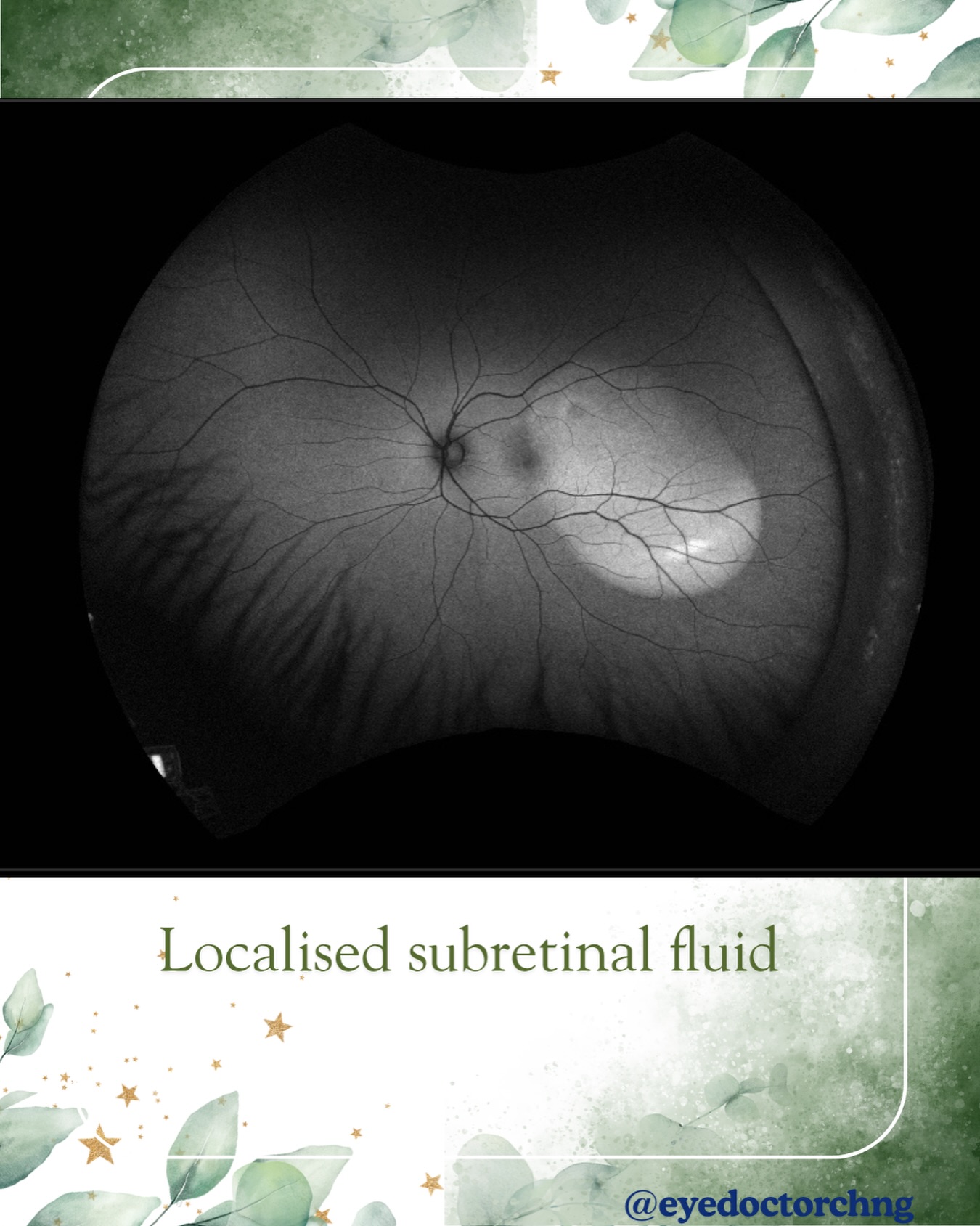 This is patient who was referred to the vitreoretinal clinic with a probable retinal detachment for surgery. As you can see from the fundus autofluorescence imaging, there is an area of hypoautofluorescence and clinically was an area of shallow subretinal fluid (SRF). This was clearly more of an exudative retinal detachment rather than a rhegmatogenous or tractional retinal detachment which requires surgery. Further investigations such as an OCT, FFA +/- ICGA and B-scan ultrasound are important diagnostic tool to find out the cause of the retinal detachment.
Here’s a little mnemonic to think of causes of subretinal fluid:
SUBRETINAL
• S — Serous / pachychoroid spectrum: eg. central serous chorioretinopathy or pachychoroid neovasculopathy
• U — Uveal effusion syndrome
• B — Blood‑vessel neovascular: eg. wet AMD or other CNVs
• R — Rhegmatogenous (± tractional) detachment
• E — Exudative / vascular leak: eg. retinal vein occlusion, diabetic macular edema, malignant hypertension, macroaneurysm or Coats
• T — Tumors: eg. choroidal melanoma, hemangioma or metastasis
• I — Inflammatory: eg. VKH, posterior scleritis, sympathetic ophthalmia or multifocal choroiditis
• N — Non‑neovascular AMD: eg. SRF over drusen or drusenoid PED (which does not respond to anti‑VEGF)
• A — Aneurysmal / polypoidal: polypoidal choroidal vasculopathy
• L — “hoLe” in the disc: optic disc pit maculopathy
#ophthalmology #retinalimaging #csr #subretinalfluid #eyedoctorchng