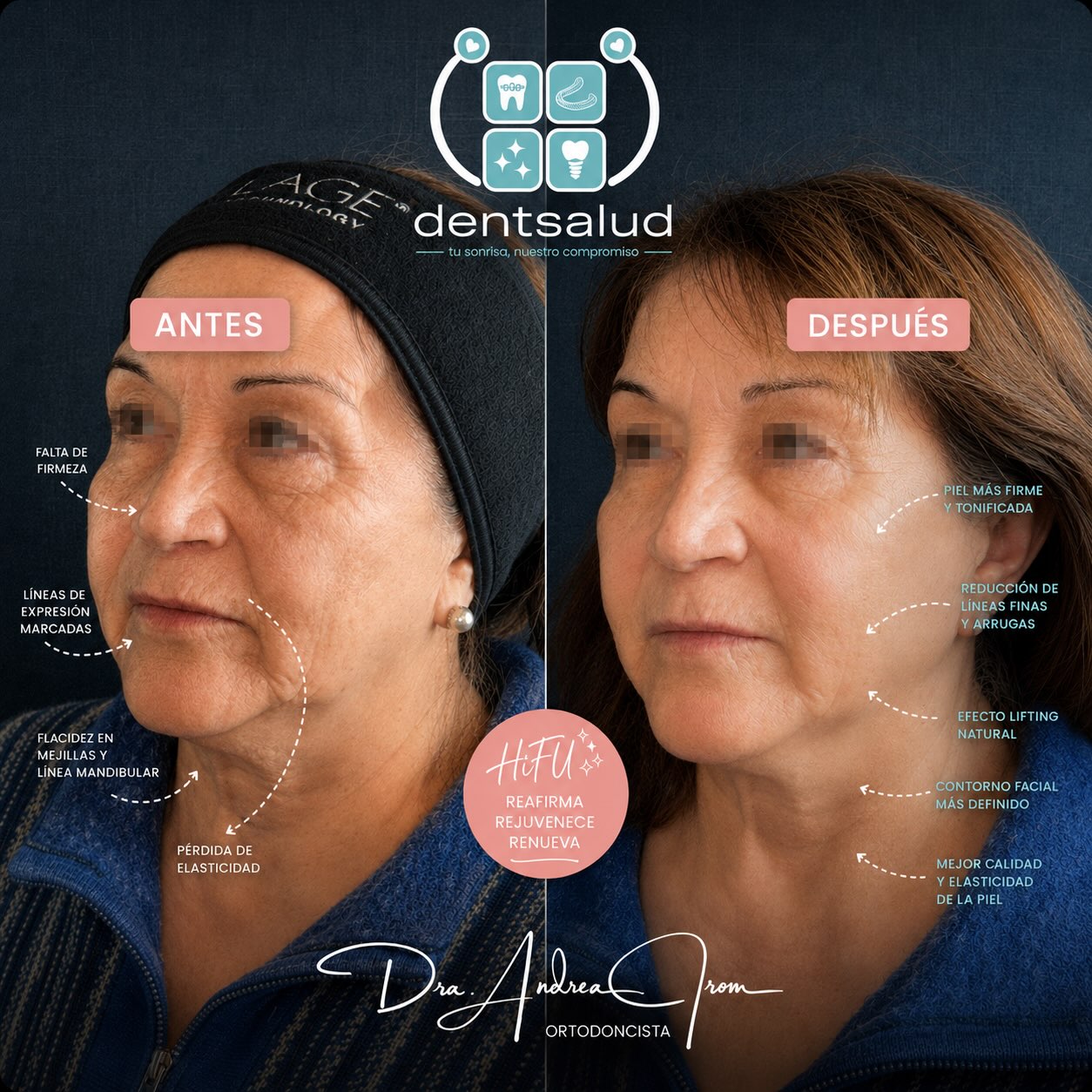 ✨ ¡Hermosos cambios que se logran con HiFU! ✨
¿Buscas mejorar la firmeza de tu rostro de manera no invasiva y sin cirugía? 💗
El HiFU (Ultrasonido Focalizado de Alta Intensidad) actúa en las capas profundas de la piel, generando estímulos térmicos controlados que favorecen la producción y remodelación de colágeno.
✨ ¿Qué podemos lograr?
• Mayor firmeza y tonicidad
• Efecto lifting progresivo
• Mejor definición del contorno facial
• Atenuación de líneas finas
• Mejoría de la flacidez facial y del cuello
• Estimulación de colágeno
• Resultados naturales y progresivos
💫 Reafirma · Renueva · Rejuvenece
Cada rostro es diferente, por eso realizamos una evaluación previa para definir las zonas y protocolo adecuados para ti.
📲 Agenda tu evaluación por WhatsApp
+56 9 9497 9558
📍 Dentsalud · Viña del Mar
Dra. Andrea From
#HIFU #HIFUFacial #LiftingSinCirugía #RejuvenecimientoFacial #Colágeno FlacidezFacial EstéticaFacial MedicinaEstética ViñaDelMar Dentsalud