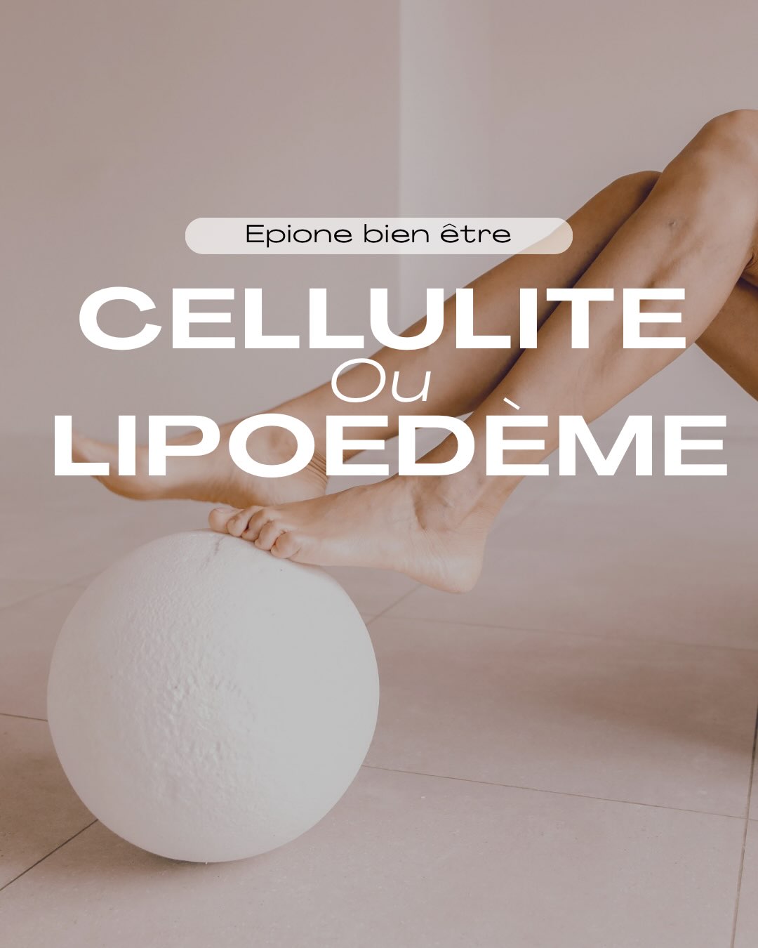 Cellulite ou lipœdème : comment faire la différence ?
On parle souvent de « cellulite » dès qu’une peau présente un aspect capitonné ou que les jambes semblent plus volumineuses.
Pourtant, cellulite et lipœdème ne sont pas la même chose.
🌸 La cellulite est extrêmement fréquente et correspond notamment à une modification de la structure des tissus graisseux sous-cutanés.
🌸 Le lipœdème est une affection chronique caractérisée notamment par une répartition particulière et souvent symétrique du tissu adipeux, principalement au niveau des jambes.
Certains signes peuvent orienter vers un lipœdème :
→ disproportion entre le haut et le bas du corps
→ atteinte généralement symétrique
→ douleurs ou sensibilité au toucher
→ sensation de jambes lourdes
→ tendance aux ecchymoses
→ pieds généralement épargnés
⚠️ Une image ou un simple « diagnostic internet » ne suffit évidemment pas pour identifier un lipœdème.
L’objectif de ce post est surtout de mieux comprendre son corps et de savoir quand demander un avis médical. 🤍
Si tu te reconnais dans certains de ces signes, tu peux en parler à ton médecin ou à un professionnel de santé formé au lipœdème.
💬 Est-ce que tu connaissais la différence entre cellulite et lipœdème ?
#cellulite #lipoedeme #lipœdème #jambeslourdes #bienetreaufeminin