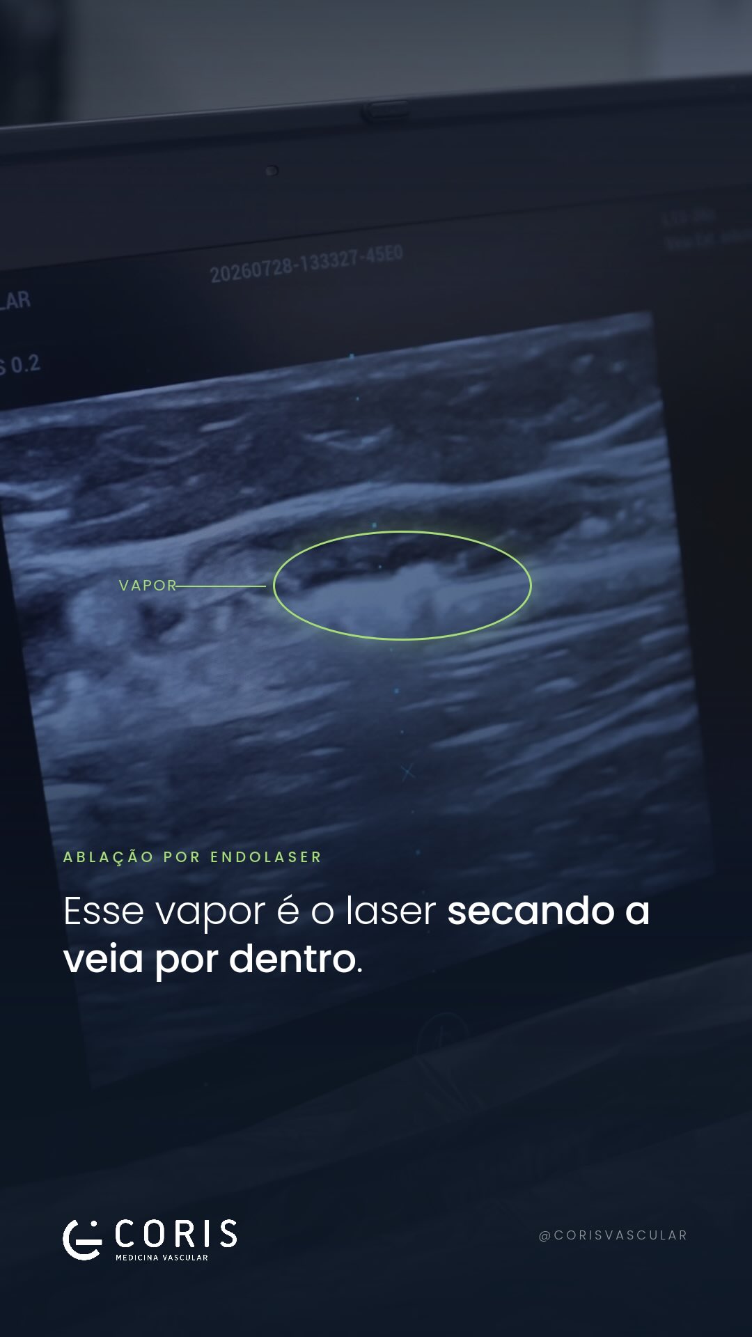 Na imagem, conseguimos ver o endolaser agindo diretamente na parede da veia.
A energia é aplicada de forma seletiva por dentro do vaso, promovendo o fechamento da veia doente. Esse vapor que aparece durante o procedimento faz parte da ação do laser.
Uma técnica precisa, minimamente invasiva e realizada de dentro para fora.