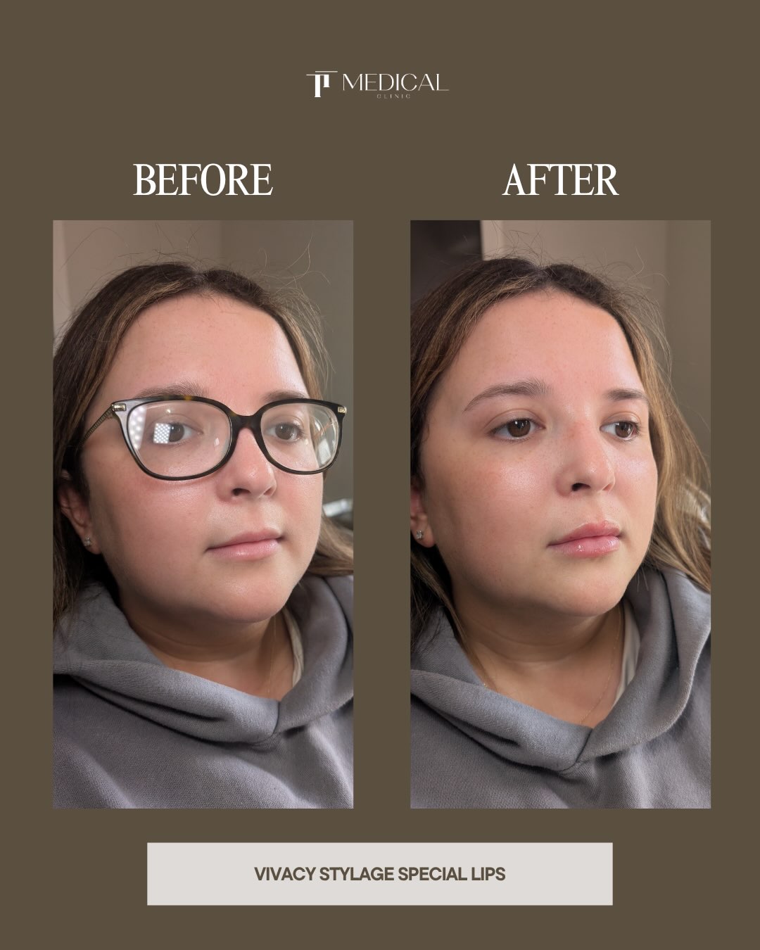 This one was never about giving her “bigger lips”. 🤍
It was about looking at her face, her proportions and what would make her feel like the best version of herself.
For this client, that meant keeping everything soft and natural while adding a little more hydration, definition and shape with Vivacy Stylage Special Lips.
You can see the difference, but you still see *her* first and that’s always the goal.
No one-size-fits-all lips. No trying to recreate somebody else’s result. Just a treatment plan built around the person sitting in front of us.
Swipe for her before + after. ✨
If you’ve been thinking about lip filler but are worried about looking “done”, send us a DM and we can talk through what would work for you.