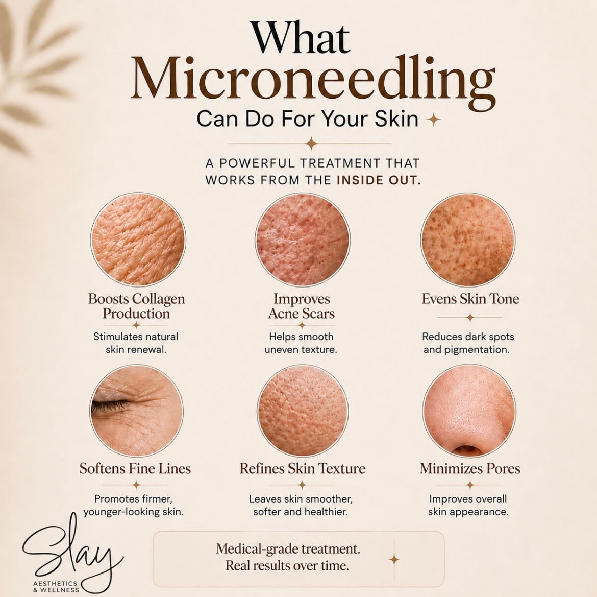 THURSDAY SKIN TRANSFORMATION ✨
Microneedling is one of those treatments where experience matters. With years of experience as a Nurse Practitioner, Shannon Francis brings a knowledgeable, personalized approach to helping clients improve the health and appearance of their skin.
Microneedling works by stimulating your skin’s natural renewal process and may help:
✨ Boost collagen production
✨ Improve the appearance of acne scars
✨ Soften fine lines
✨ Refine skin texture
✨ Minimize the appearance of pores
✨ Improve overall tone and texture
At Slay Aesthetics & Wellness, Shannon offers more than skincare—she can help create a treatment plan based on your individual aesthetic and wellness goals.
Services include:
💉 Botox & Xeomin wrinkle relaxers
💋 Dermal filler
✨ Radiesse collagen stimulator
🌿 Microneedling
⚖️ Medication-assisted weight loss
🌸 Women’s hormone replacement therapy
Ready to invest in your skin and feel confident in your treatment plan? Schedule your consultation with Shannon.
BOOK:
https://slay-aesthetics.janeapp.com/
WEBSITE:
https://slay-aesthetics.com
CHERRY FINANCING:
https://www.slay-aesthetics.com/payment-plans
#SlayAesthetics #Microneedling #TransformationThursday #NewarkOhio #ohioaesthetics