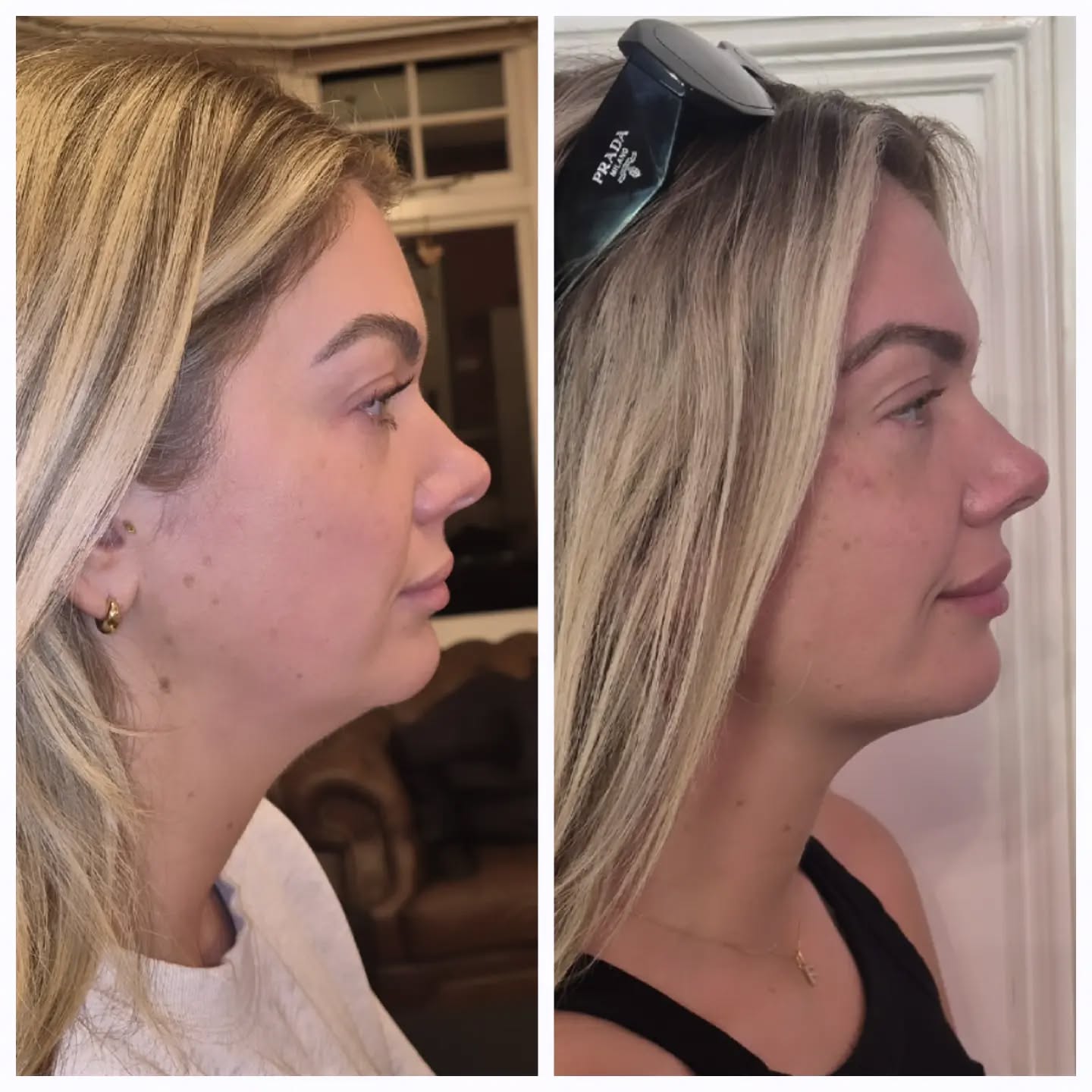 AQUALYX BEFORE & AFTER
And this is only after ONE session out of three.
Already a massive difference to the appearance of the double chin, with a much more defined jawline and improved lower-face profile.
Aqualyx works by targeting and breaking down stubborn pockets of fat, which are then naturally eliminated by the body over time.
This client still has 2 sessions to go, so we can’t wait to see the final result.
Results vary from person to person and a consultation is required to assess suitability.
#Aqualyx #FatDissolving #DoubleChin #JawlineDefinition #BeforeAndAfter BournemouthAesthetics ReemMedicalAesthetics