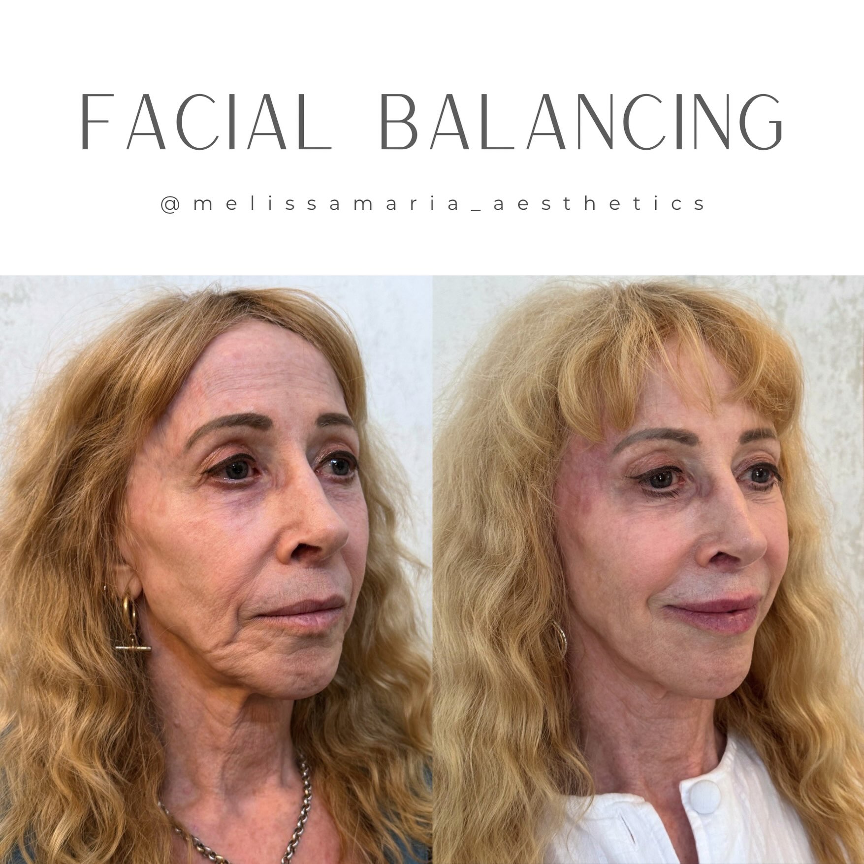 The flex here is that we were able to use significantly less filler because we worked on her laxity first. This was not in 1 session it was a transformation that occurred over 8 months. She was not wanting to look 20 she just wanted to look good for her age.
Slow and steady wins the race. By addressing skin first we were able to reverse the age of her skin before ever adding filler. You can/should only put filler in certain areas and you should only use a certain amount of filler in each area.
Had we started with filler she would “need” a ton of filler to her cheeks, jawline, NLF and all of that would be a bandaid. Overall she had laxity due to aging and that had to be treated first.
We did do several syringes of filler after. However, she does not look like she’s had filler and her face and neck look like they all aged/ anti aged at the same rate. Everything looks cohesive. That’s because we didn’t spot treat with filler we started with softening her entire face and addressing her laxity before adding more weight to skin that was already struggling.
How many years do you think we took off?
Skincare + Morpheus + coolpeel + Biostim + filler + Tox for the win
#trusttheprocess
#medsparaleigh #facialbalancing #facialbalancingraleigh #facialbalancinggreensboro facialbalancingCharlotte