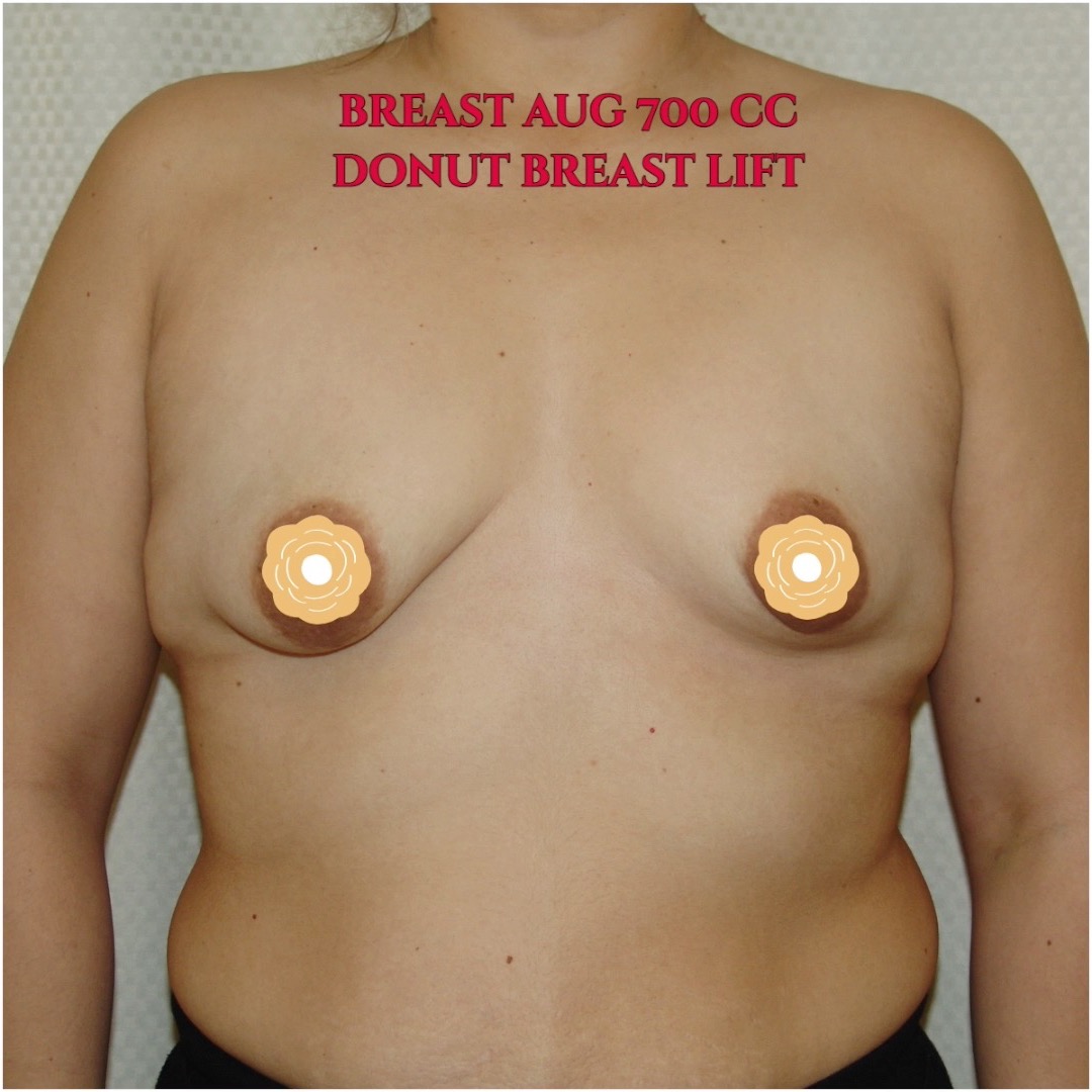 This woman has "tubular" shaped breasts. I placed 700 cc implants with donut breast lift. The scar is only around the areola and very faint. She now loves her new double DD breasts and higher nipples. Call now for our Mid-Summer Specials! Saline Breast Aug -->$3995 Silicone Breast Aug --> $6495 Tummy Tuck starts at --> $7995. Call (714) 500-0050 #drluudoan #breastaug #salineimplants #siliconegelimplants #tummytuck #abdominoplasty