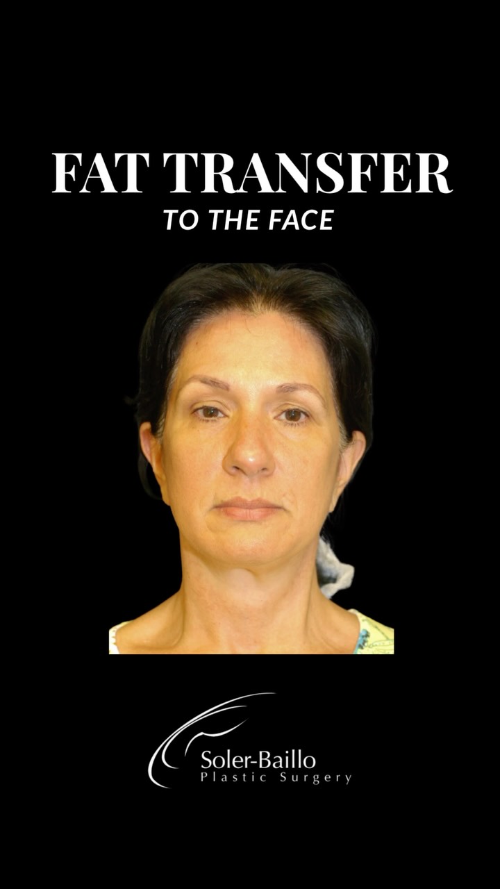 🪞Refresh. Rebalance. Rejuvenate.
A youthful face isn’t simply about adding volume. It’s about knowing where volume belongs.
Using a combination of nano and micro fat grafting, Dr. Soler Baillo strategically restored volume, softened areas of deflation, and enhanced the natural proportions of the face for a refreshed, more youthful appearance.
✨ Subtle volume
✨ Improved facial harmony
✨ Natural-looking rejuvenation
The goal? Still you, just beautifully rebalanced.
📩 DM us to learn more about facial balancing with fat grafting.
#FacialBalancing #FatGrafting #FacialRejuvenation #NanoFat #MicroFat