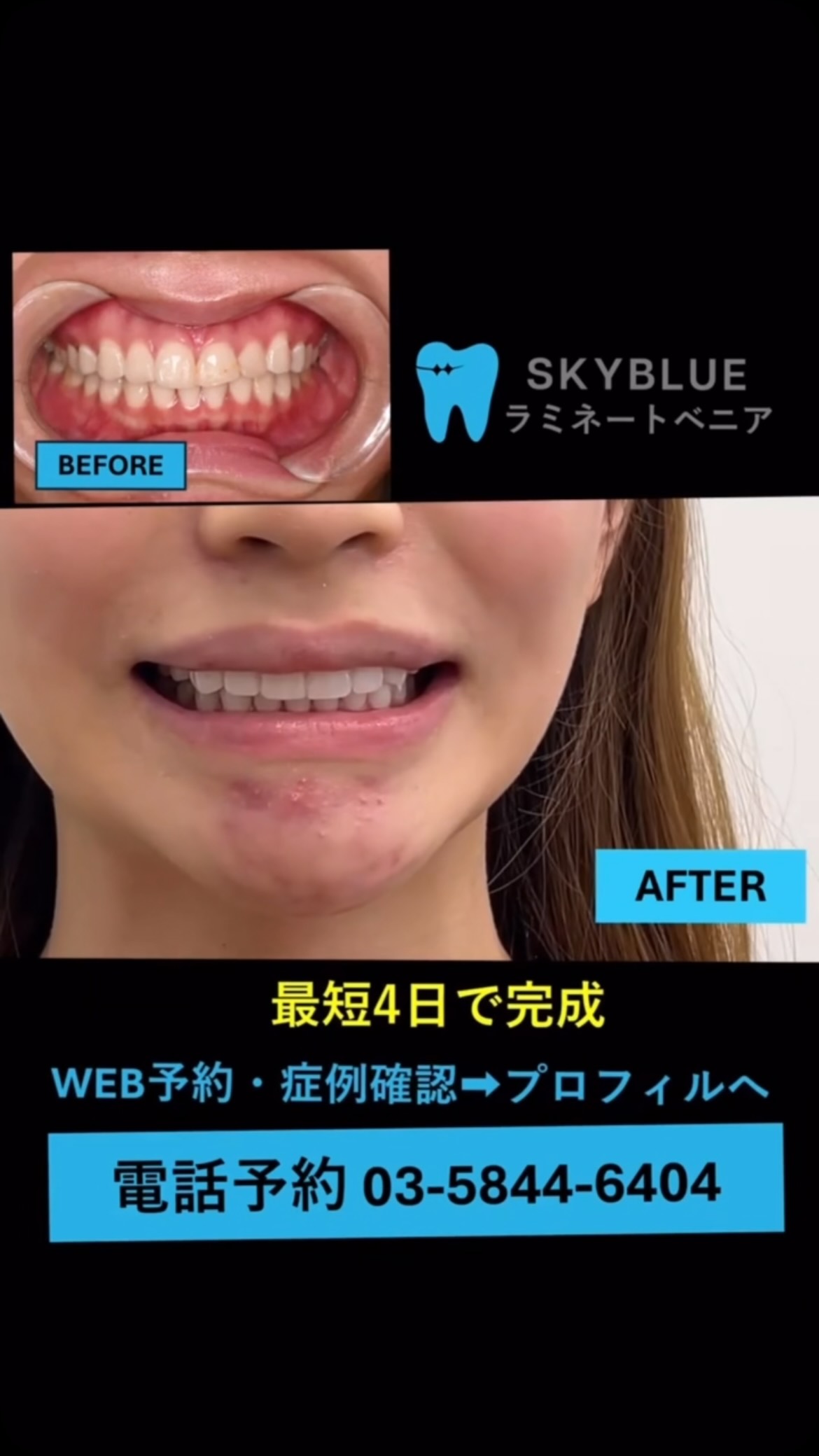 最短4日で完成
➡️ モニター価格 20%OFF🎁
「前歯の形や色が気になる」
「自然で美しい口元になりたい」
そんな方はぜひこの機会にご相談ください🦷
【📝モニター価格適用条件】
✔ Before & Afterのお写真撮影にご協力いただける方
✔ Googleレビューをご投稿いただける方
「前歯の形を整えたい」
「短期間で歯列を改善したい」
「ホワイトニングでも白くならない歯が悩み…」
そんな方は、
SKY BLUE歯科のラミネートで
自然歯への負担に配慮しながら、
自信の持てる口元を目指してみませんか?
【📝モニター価格適用条件】
1. Before&After撮影同意
2. 院内コンテンツ撮影同意
※お顔はモザイク処理を行います
3 20代 女性
治療期間 5日(最短4日で完成)
治療費用 1本62000円×12本
考えられる副作用 ベニアが割れる・剥がれるの可能性、虫歯・歯周病のリスク、歯の神経へのダメージの可能性
#ラミネートベニア #無削除ラミネート #審美歯科 #セラミック治療 #歯を削らない #口元美容 #歯並び改善 #歯科医院 #矯正歯科 #文京区 #春日駅 #後楽園駅